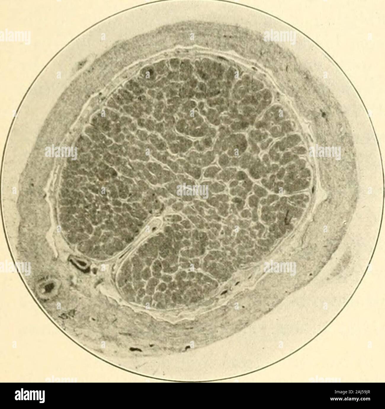 Die Neurologie des Auges Ein Handbuch für Nerven- und Augenärzte . von einseitiger retrobulbärer nevriti, der mitplötzlicher Erblindung anfänglich ganz ophthalmoskopische das Bild der Embolieder Centralarterie dargeboten hatte. Schon am Abend desselben Tages guerra dasSehvermögen aber wieder besser geworden (dito exzentrisch in 2 baccano, verschiedene Defekte imGesichtsfelde, darunter auch ein centrales Skotom), die Arterien wieder gefüllt normale. Inden nächsten Tagen nahm die Retinaltrübung in der Gegend der Macula noch zu, gingaber bald völlig zurück, während sich jetzt an der Papille das bild Foto Stock