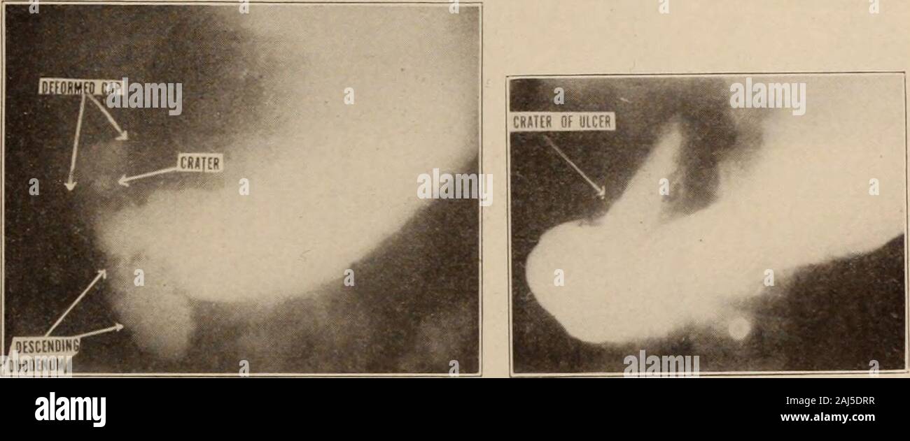 Interstate medical journal . n eseguiti. Microsection dimostrato nonmalignancy. Storia successiva: paziente ha sviluppato polmonite lobar sulla seconda dayand soccombettero. INTERSTATE MEDICAL JOURNAL 33 caso VI.* (Fig. 6.) La storia clinica: il dolore acuto all epigastrio per due settimane, venendo twohours dopo aver mangiato, alleggerita da alcali. Roentgen diagnosis: Una piccola ulcera punctate sulla curvatura meno accentuata sur-faccia della calotta, senza indurimento o contrazione cicatriziale. Storia successiva: questo paziente seguito un rigido trattamento medico forulcer per un periodo di due settimane, alla fine del quale il tempo tutti di t Foto Stock