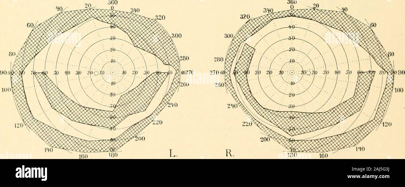 Die Neurologie des Auges Ein Handbuch für Nerven- und Augenärzte . 120% &gt;220 -X;- ,. ,,/L20 20(T 180 L. R 180 160 Fis?. 30. Dora K. Das Gesichtsfeld von Fig. 29 3 Jahre später. Eigene Beobachtung. Reste einesRingskotoms bei la retinite pigmentosa. Sehschärfe. Emmetropie S = 6/i2 link. Verschlechterung gegen 12. IV. 96. - 1,25 S = B;i8 rechts.Zustand des Gesichtsfeldes am 26. IV. 96 vedi fig. 30.. Fig. 31. Hertha K , Schwester von Dora K., Fig. 30. Eigene Beobachtung. Ringskotom bei la retinite pigmentosa. Bertha K., 16 Jahre, Dienstmädchen. Schwester von D. K., dem eben beschriebenenFalle. Essere Foto Stock
