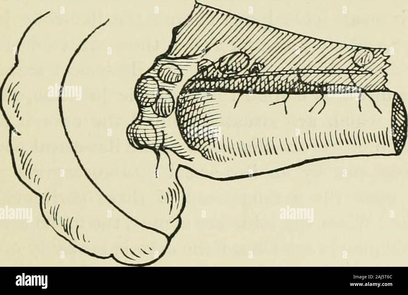 In alcuni punti l'anatomia, la patologia e la chirurgia di intussusception . Fig. 22.-l'ileo-coliche angolo di achild invecchiato 15 settimane. L'ileo-coliche fossa è incompleta e tlieaxis dell'ileo è convesso verso il basso-reparti. Fig. 23.-l'ileo-coliche angolo di una ragazza di età compresa tra 14anni. L'ileo-coliche piega (a), e l'ileo-ciccal piega (h) sono insolitamente ben sviluppata.L'asse dell'ileo è pressoché orizzontale. completa di fossa, che di solito è coesistente con il semplice tipidi montanti cieco (tipi A e B di Treves, Fig. 25), è quella in cui la. Fig. 24.-l'ileo-coliche angolo di un bambino di età compresa tra 8 settimane. L'ileo-coliche foss Foto Stock