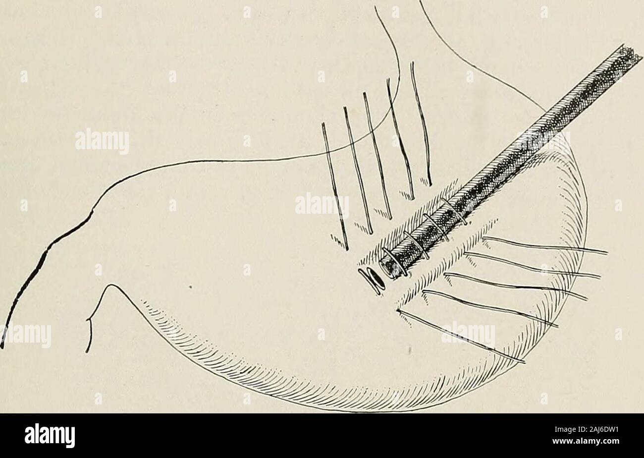 Trattamento chirurgico; una pratica trattato sulla terapia delle malattie chirurgico per l'uso di professionisti e studenti di chirurgia . uno di stomaco viene aspirato fuori attraverso una seconda piccola ferita nella parete addominale e cucito veloce. cision 2 cm. ("%") Lunga viene realizzato parallelo al primo circa 2,5 cm. (1 poll.) al di sopra del margine costale, e trasportato attraverso la cute e fascia superficiale.La pelle tra le due incisioni è compromessa. Lo stomaco a thecardiac fine viene captato e tirato fuori abbastanza lontano per raggiungere i piccoli open-ing, e fissato al peritoneo e fascia da quattro punti di sutura. L'apice o Foto Stock