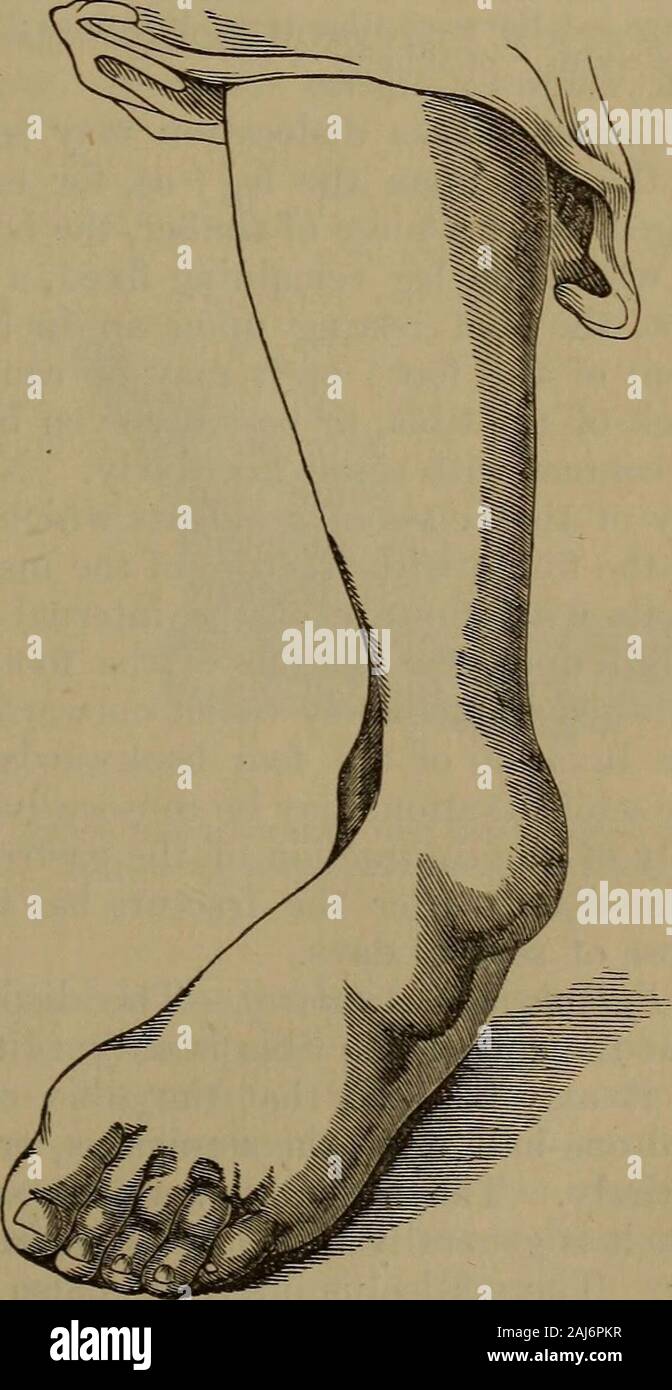 Una pratica Treatise on fratture e lussazioni . margine, o la tibia, con il perone, di FlG-337- corso, possono effettivamente far scorrere fuori-reparti fino alla estremità inferiore della tibia più o meno completelyabandons la superficie superiore dell'astragalo. Le modalità di riduzione, eil principi generali di trattare-mento successivamente, non dif-fer da quelle che abbiamo havementioned come adatto per dis-locations in senso opposto direc tion. Gli esempi che havefallen sotto la mia osservazione nonsono numerose ma il reductionhas sempre stata effettuata facilmente.Così, un uomo, set. 21, cadde dauno impalcature, scende Foto Stock