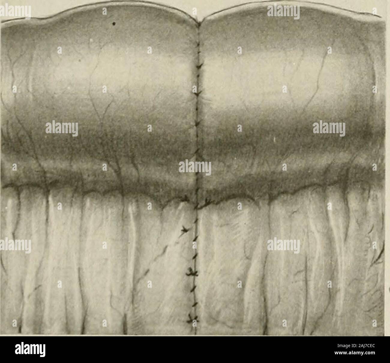 Trattamento chirurgico; una pratica trattato sulla terapia delle malattie chirurgico per l'uso di professionisti e studenti di chirurgia . Fig. 1312.-collocando il Serosa Strato di suture. Il primo strato di suture è stata posizionata; le guide sono state inserite; e il parallelo interrotto materasso suture vengono applicati.. Fig. 1313.-Una anastomosi termino-terminale completato.il calibro dell'intestino è aumentata nel luogo di anastomosi dall'obliquità della sua divisione. Dopo aver completato la seconda fila, strumenti vengono rimossi, il mesen-teric ferita viene chiusa con un paio di suture interrotto (Fig. 1313), il b Foto Stock