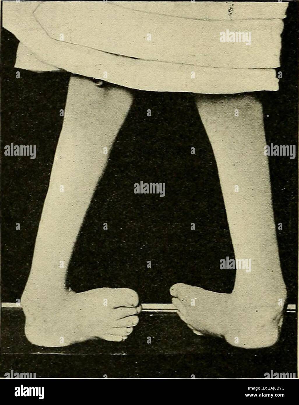 Un trattato di chirurgia ortopedica . Egli tabella la gamba è tenuto in posizione verticale. Questo allowsone per agganciare le dita sulle estremità del os calcis, mentreil la mano e il braccio disteso lungo la pianta del piede, può essere usedas una leva per forzare verso di flessione dorsale come os calcis isdrawn verso il basso. In questo modo lo stiramento forzato è la con-tinued fino al dorso del piede può essere portato quasi intoapposition con la cresta della tibia. Quando il funzionamento hasbeen completato il piede deve essere perfettamente limp. Esso è di solito52 818 OETHOPEDIC SrSGEEY. someTvhat congestionato dalla pressione delle dita, Foto Stock