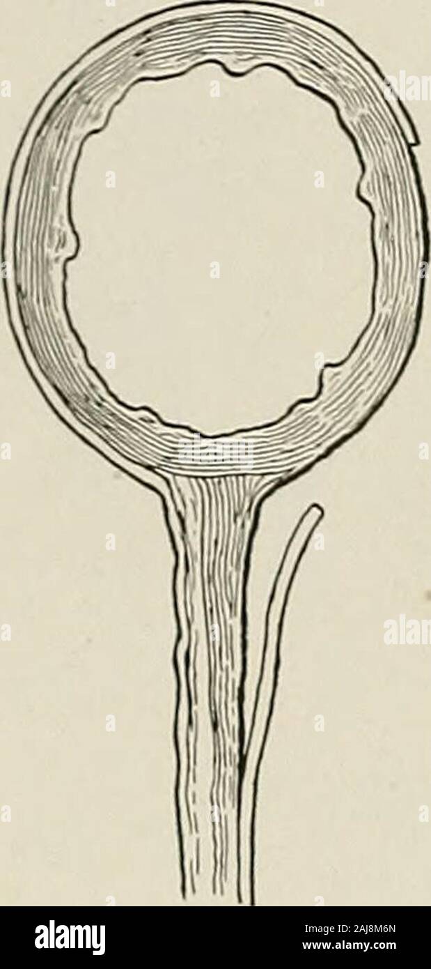 Trattamento chirurgico; una pratica trattato sulla terapia delle malattie chirurgico per l'uso di professionisti e studenti di chirurgia . Fig. 1210.-completato peritoneale in plastica per la copertura superficiale denudata su intestino.Mostra le possibilità di alette di plastica del peritoneo. plicable del piccolo intestino e il mesenterio che contiene un fairamount di grasso. Un altro materiale che può essere utilizzato per questo scopo è il omento-ma questo lascia l intestino aderente al omento a meno che non sia un innesto omental è 5-44 5I -RGICA L TREA TMEN T utilizzato (Fig. 1213), e che è meno adatta per il successo di un'operazione con un Foto Stock