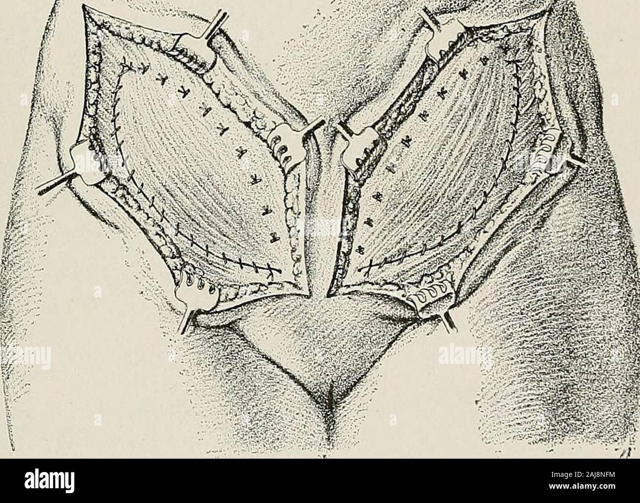 Trattamento chirurgico; una pratica trattato sulla terapia delle malattie chirurgico per l'uso di professionisti e studenti di chirurgia . d di tutto ma la pelle superficiale e di scudo. L'ADDOME 541 questi due lembi sono sovrapposti l'uno di fronte all'altro e tenuti da twovertical righe di suture. Le suture possono fuoriuscire attraverso il semilunarlines. Per riprendere il gioco verticale, le ferite trasversali sono overlappedin allo stesso modo. Materasso suture combinato con suture continue ofchromicized catgut sono utilizzati. Il rilassamento della parete addominale, che è comunemente visto in lowerabdomen, e è d Foto Stock