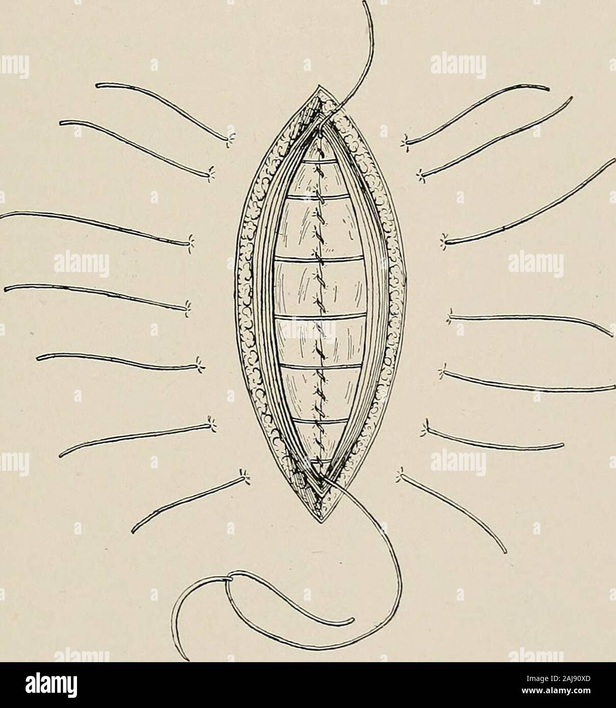 Trattamento chirurgico; una pratica trattato sulla terapia delle malattie chirurgico per l'uso di professionisti e studenti di chirurgia . Fig. ho 190.-Schema della ferita addominale completamente suturato in strati.peritoneo, fascia transversalis, lo strato anteriore di fascia lata e la pelle sono cuciti ciascuno separatamente. Il terzo livello di suture dovrebbe abbracciare la guaina anteriore del muscleand la fascia superficiale con il suo tessuto areolare e grasso. Se lo strato di grasso è molto spesso un supplemento di sutura sottocutanea deve essere utilizzato. Queste sono runningsutures delle belle chromicized catgut, e sono destinati a chiudere tutti i s Foto Stock