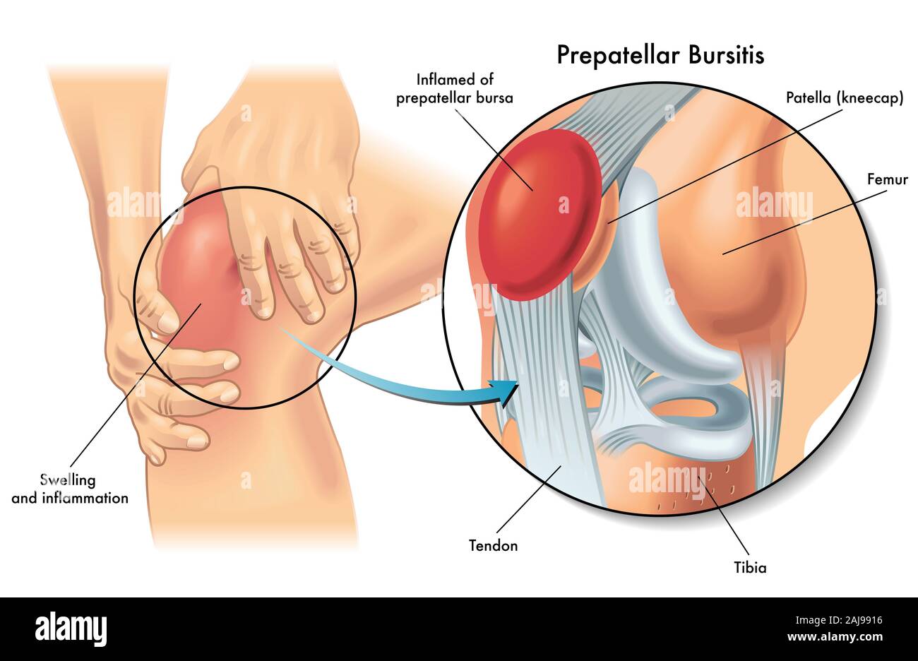Illustrazione medica mostra anatomia della borsite prepatellar condizione del ginocchio umano. Foto Stock