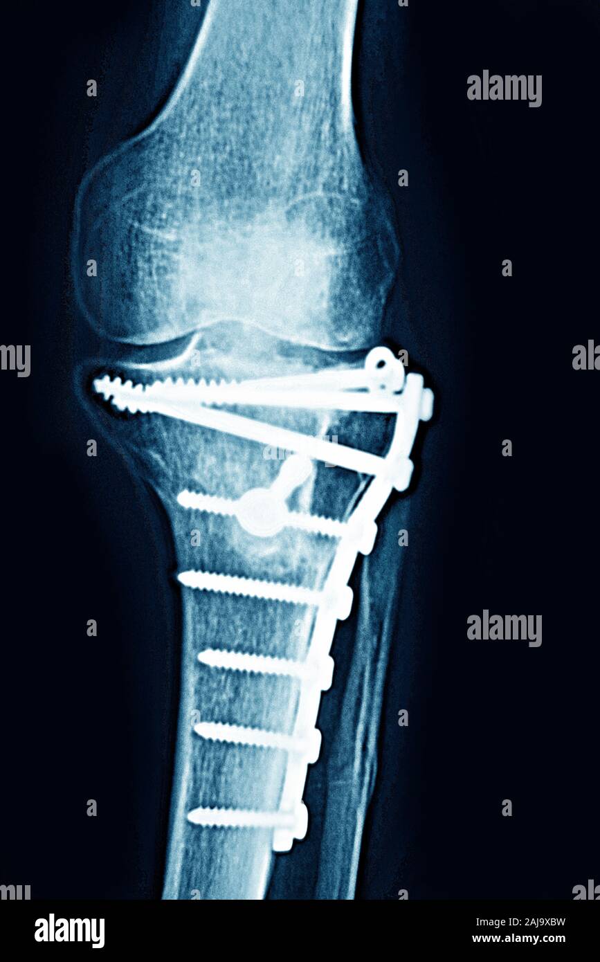 Osteosintesi sulla tibia Foto Stock