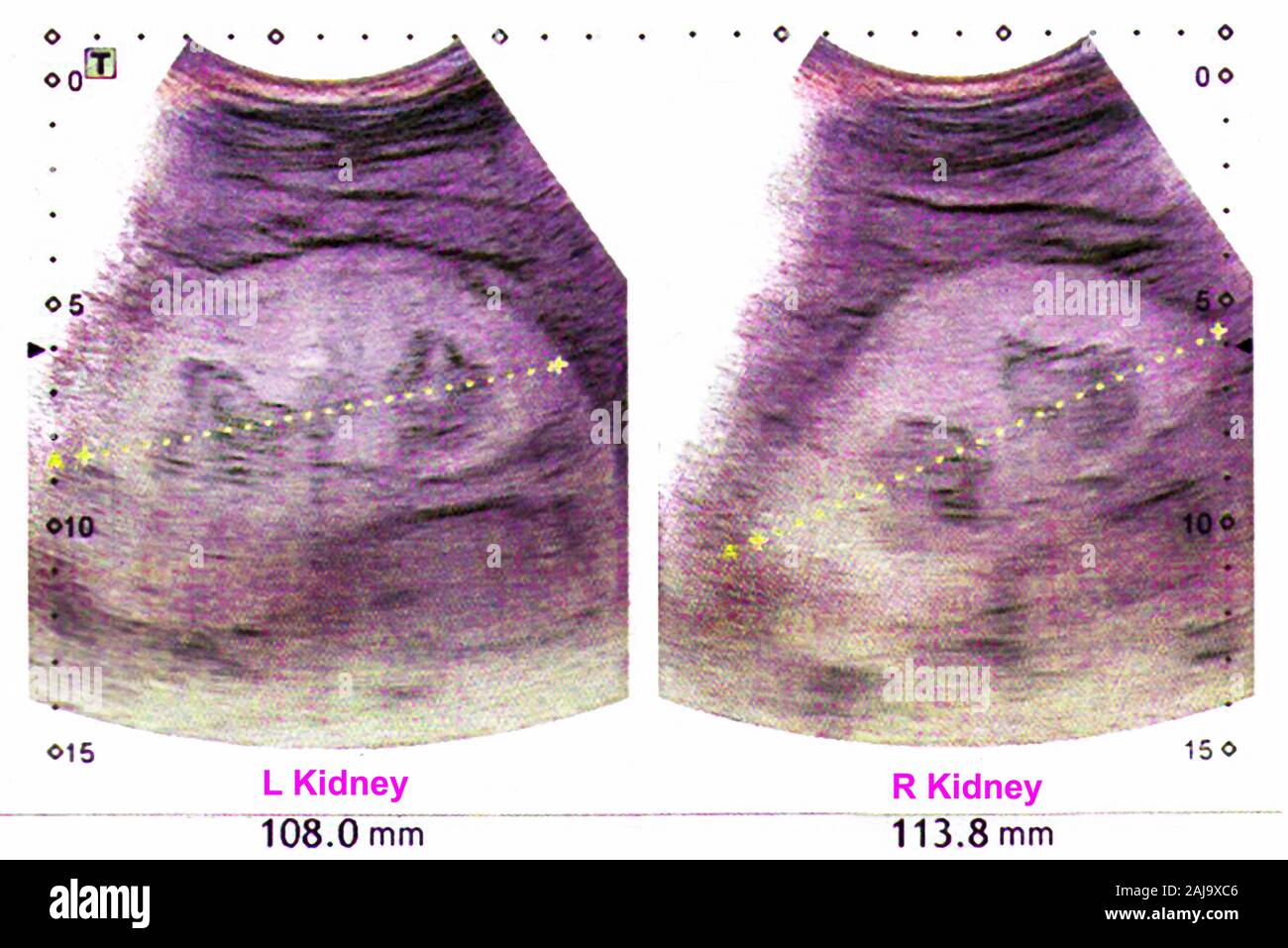 Ultrasuoni Kidneus Foto Stock