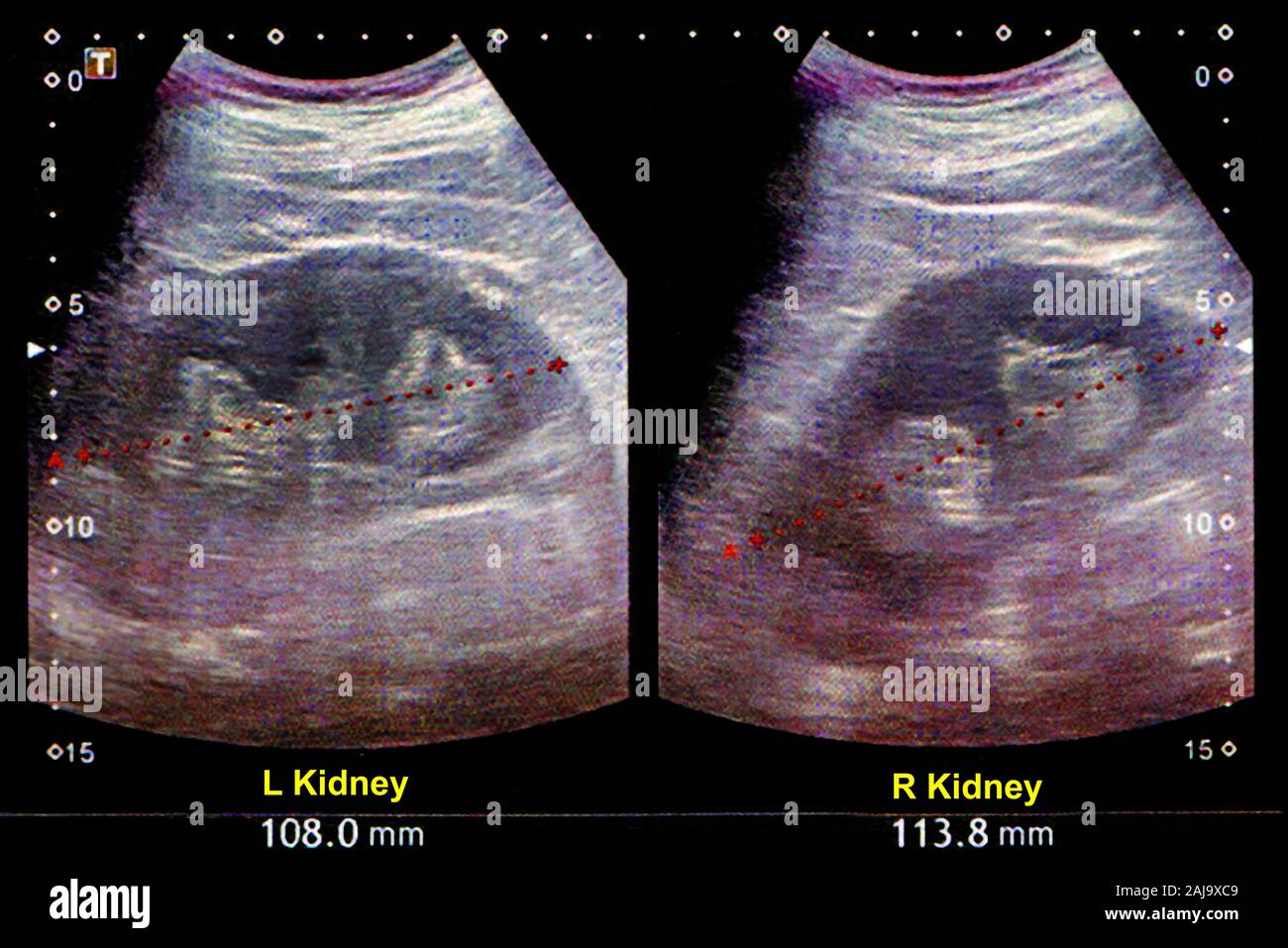 Ultrasuoni Kidneus Foto Stock