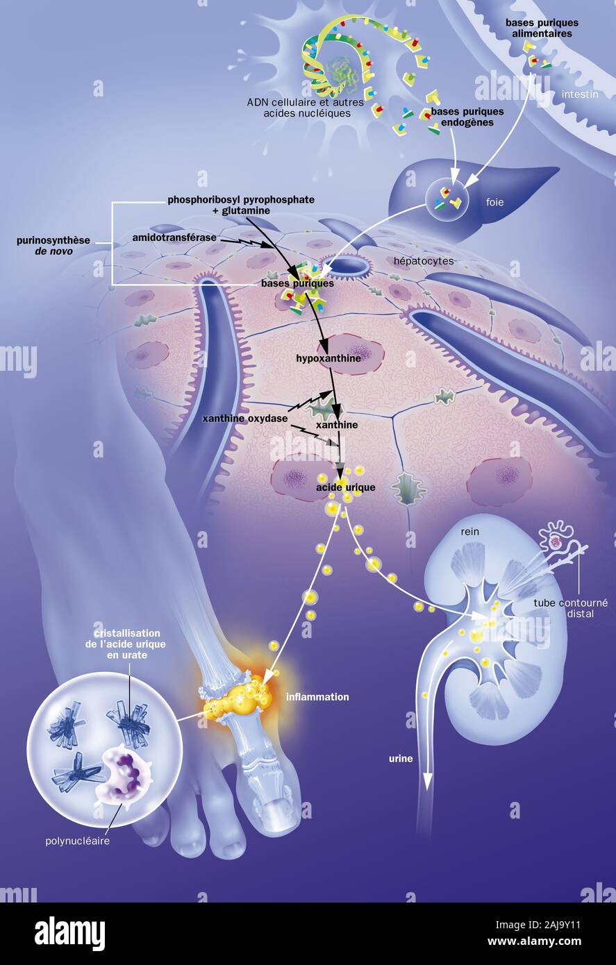 Acido urico produzione di epatociti, infiammazione delle articolazioni, urolitiasi, trattamenti. Nella parte superiore, la produzione endogena di basi puriniche a livello di t Foto Stock