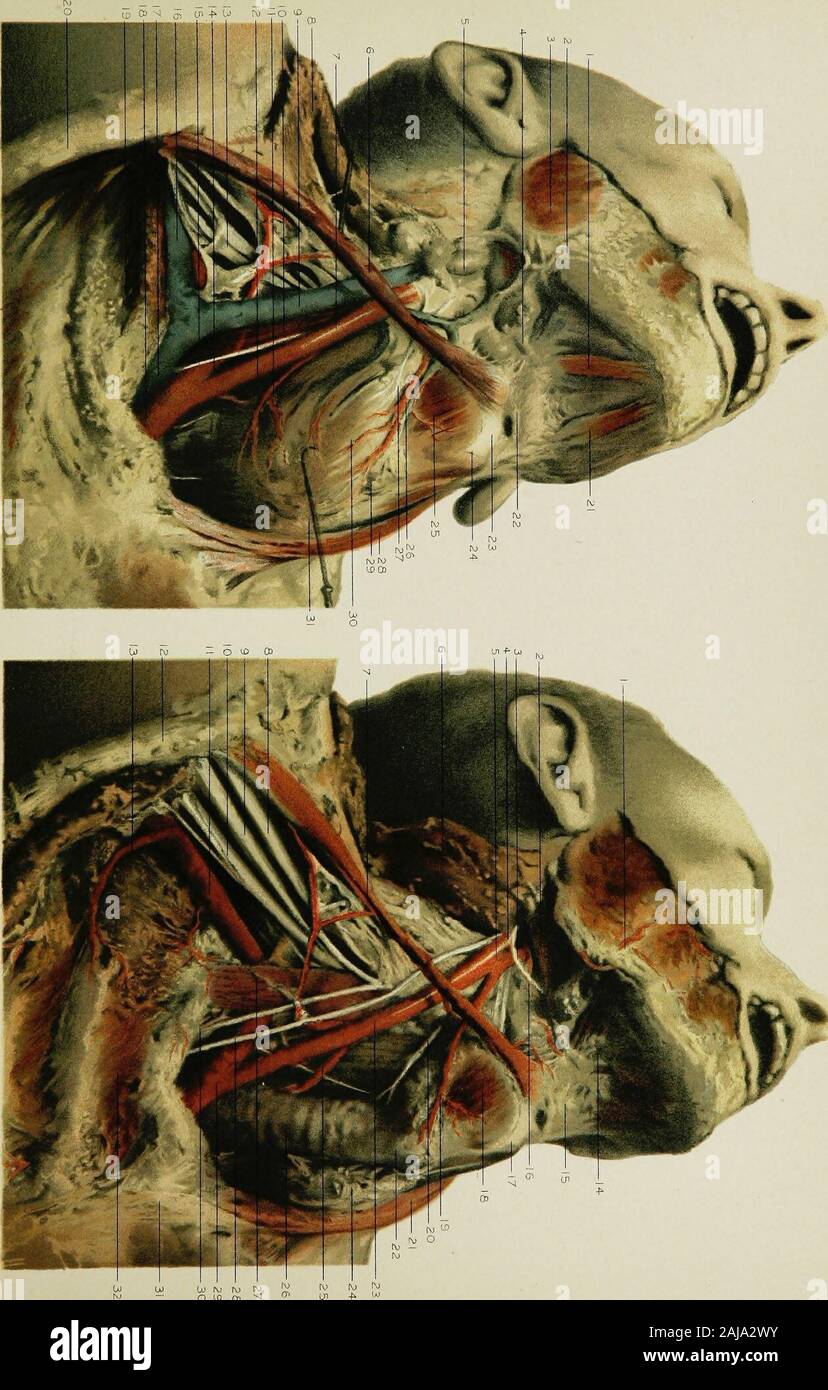 Anatomia regionale nella sua relazione alla medicina e chirurgia . tric muscolo. La arteria carotide esterna. La carotide interna. La biforcazione della carotide comune. Il sterno-muscolo mastoide, rivolto all'indietro. L'omo-hyoid muscolo, disegnato da parte. Il cavo di alimentazione esterna del plesso brachiale. Il centro cavo del plesso brachiale. Il cavo interno del plesso brachiale. L arteria succlavia. La clavicola. Il superiore del torace ramo della arteria ascellare. La porzione anteriore del muscolo digastric. Il corpo del hyoid osso. L arteria linguale e del nervo ipoglosso. 17. La tacca della tiroide. 18 Foto Stock