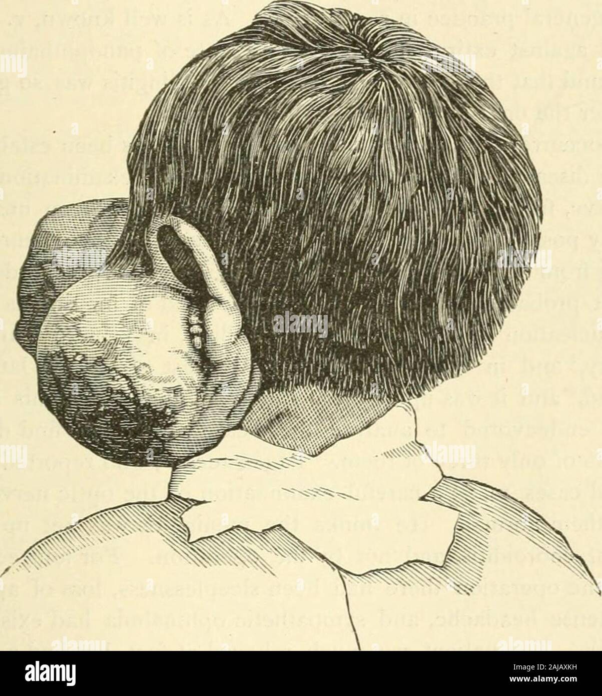 Le transazioni . Il dott. Dyers caso del sarcoma della congiuntiva. 541 Coperchio burst, seguita da emorragia allarmante. Come i tumori sono cresciuti insize, le fessure nella pelle sono stati aperti più ampia e, come la rottura di vesselswere, emorragie fresco si è verificato. Come ho vissuto a dis-tanza dal paziente, non ho mai visto uno di loro, ma il dott. McKelvy,che era vicino a portata di mano, mi dice che non ci sono dodici o più ; thatthey erano molto brusco e abbondante, da otto a dieci once, ma che theywere venosa ed erano generalmente ha cessato da tempo è arrivato, andwere evidentemente cutanea. Le fotografie allegate showthe dimensione del t Foto Stock