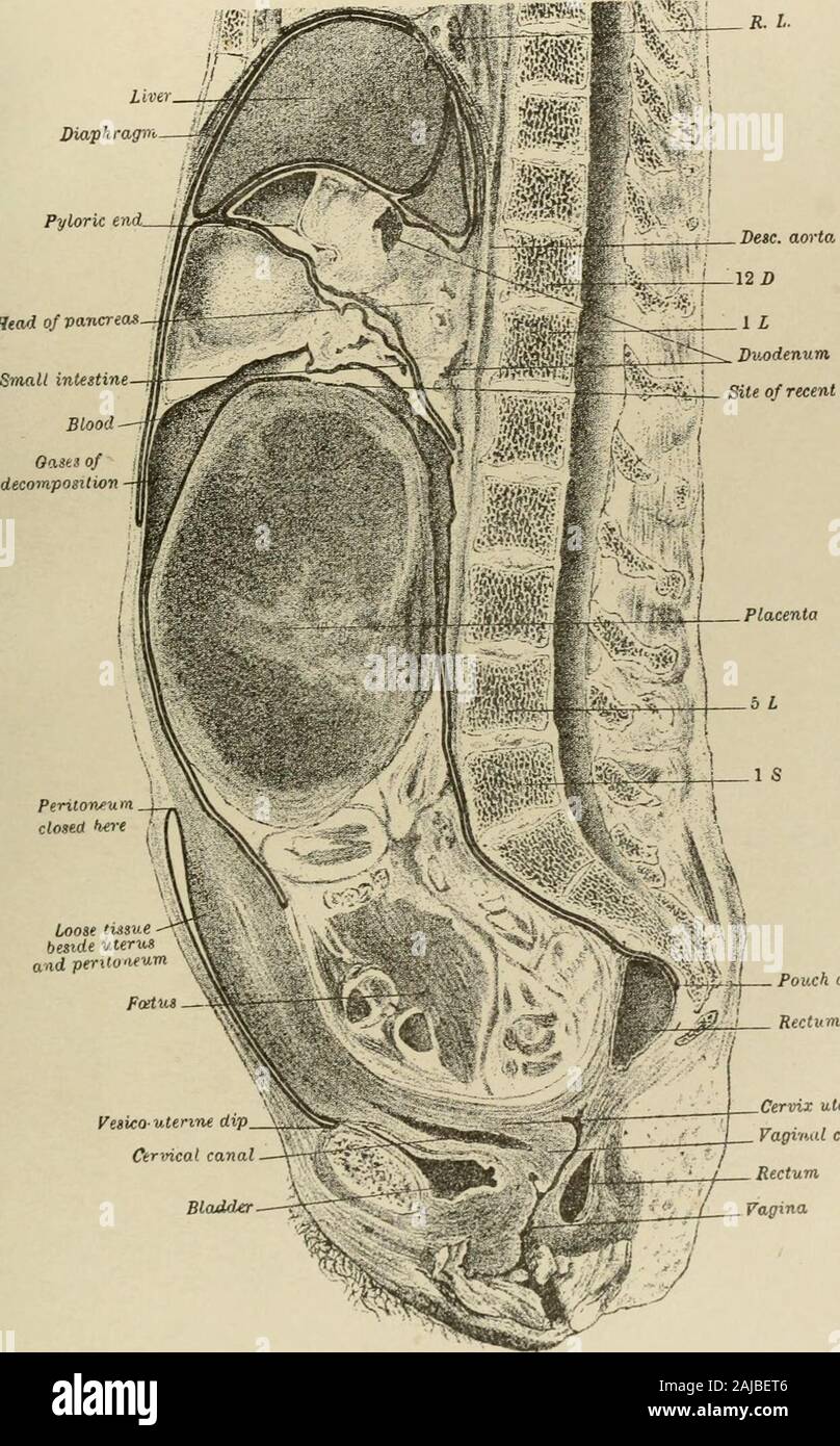 Extra-Uterine gravidanza; una discussione . - Sacchetto di I&GT;ouglat canale cervicale sagittale sezione mediale del bacino stesso, mostrando utei-iis con ileciclu;i. Questo sectiondemonstrates, inter alia, tliat qual è tcnncil cliniciilly retro-lieiiia uterina1&lt;icele. forse bematomata.-Tait. [Da Annali di Gijnecologjf, Boston, Feljruaiy, 18S0. Da peniiission.] PIASTRA V. Diaiph, Pilorica agvi fine. Testa di vancrea" del sito di recente rottura. ioose (issve accanto all utero e perxtu tfum .,lyj sacca di DoiLglos VeiKO ixUnnt dip,Ctrmcal canal collo della vescica uleHVaginal cervice RectumVagina iiKr sagittale^ial si&GT;c Foto Stock