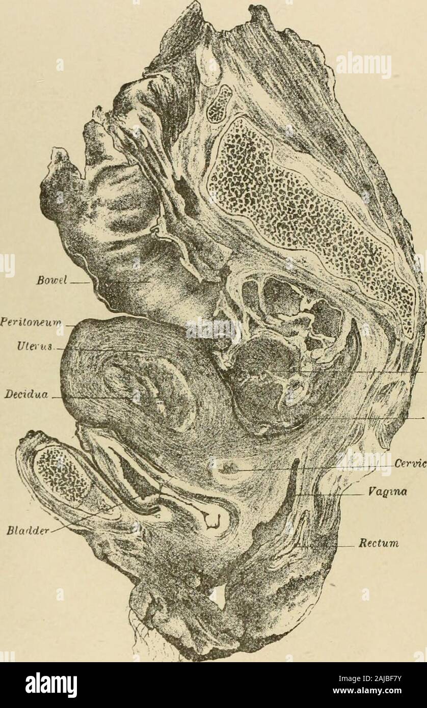 Extra-Uterine gravidanza; una discussione . Feto Ckorion wi£^fA. Otturatore internua KJiJf/ ievatnr hmi lissve Paraproctal sagittale sezione laterale (rijrht) ol pelvi, con extra uterine di gestazione in destra ampia legamento.-T.mt. [Da Annali di ginecologia, Boston, Febbraio 18S0. Da pennlssion.] PIASTRA IV.. - Sacchetto di I&GT;ouglat canale cervicale sagittale sezione mediale del bacino stesso, mostrando utei-iis con ileciclu;i. Questo sectiondemonstrates, inter alia, tliat qual è tcnncil cliniciilly retro-lieiiia uterina1&lt;icele. forse bematomata.-Tait. [Da Annali di Gijnecologjf, Boston, Feljruaiy, 18S0. Foto Stock