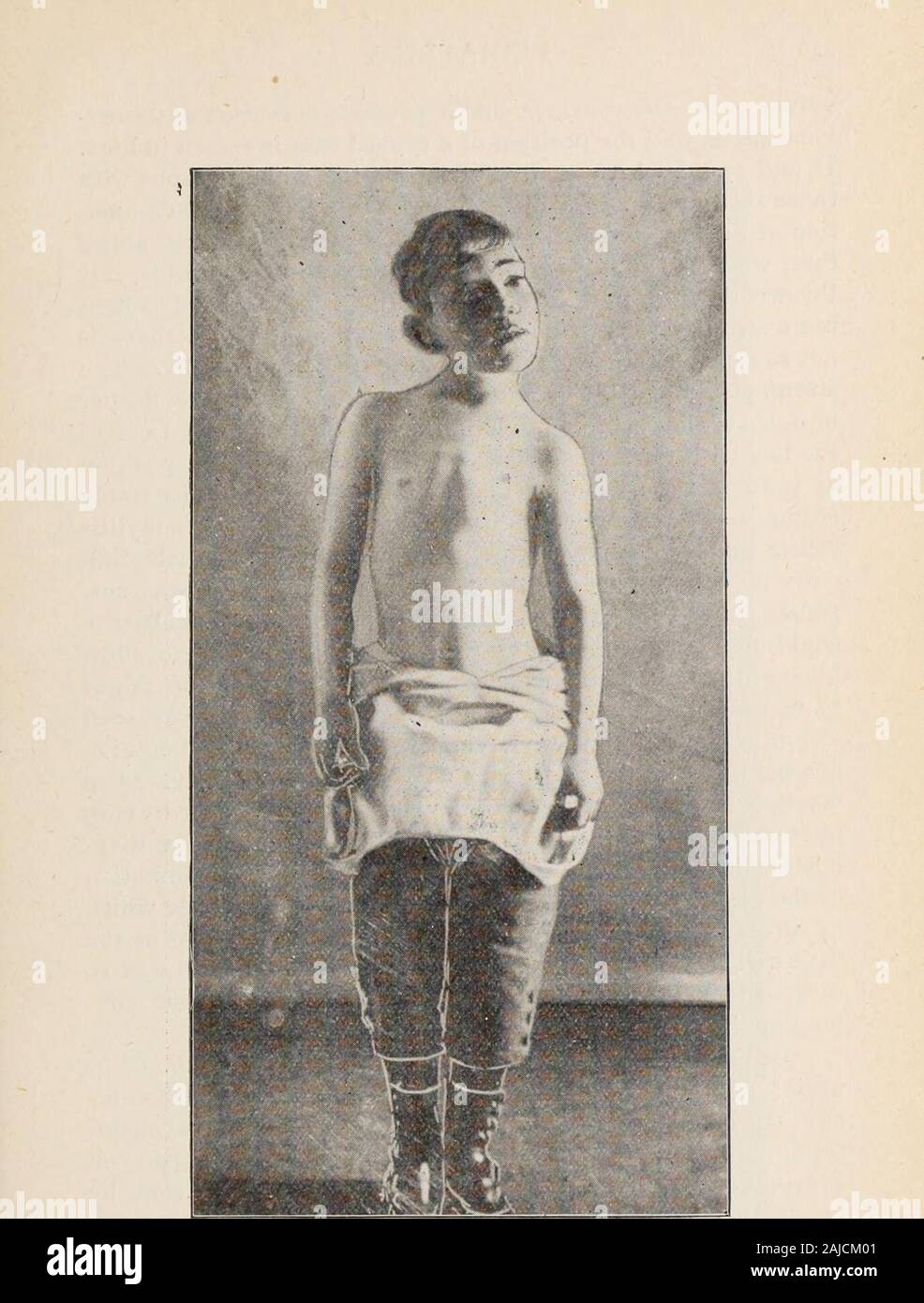 Pediatria. . Fig. 17.. Fk;. 18. 248 pediatria. vature della colonna vertebrale, ad eccezione del fatto che si tratta di curvatura laterale del cer-vical colonna vertebrale e la posizione di un caso tipico è mostrato nelle Figg.18 e 19. Vi auguro potrebbe contrastare queste fotografie withthose visto in Fig. 20, che sono quelle di un ragazzo con inflamma-zione della prima e della seconda vertebra cervicale. Si noticethat, mentre il mento è gettato nel caso di torcicollo, isthrown verso il basso nel caso di anchilosante-che la testa è bentmore fortemente a lato nel anchilosante e che vi nonè tanto la rotazione in quanto non vi è nel caso Foto Stock