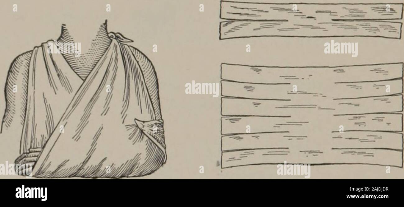 Primo anno di assistenza infermieristica : un libro di testo per gli alunni durante il loro primo anno di lavoro ospedaliero . ess non deve essere sacrificato all'aspetto. Bendaggio triangolare.-Questo è costituito da un quadrato ofmuslin, piegato in diagonale. Essa può essere di piccole o grandi dimensioni,secondo l'uso che se ne deve fare. Imbracatura del braccio.-Il bendaggio triangolare dovrebbe essere messo conla il punto in corrispondenza del gomito, la piegatura al polso e Idue termina ogni lato del collo, la legatura sul retro. Thepoint dovrebbe essere ripiegata sotto e ordinatamente riposte. La 253 254 Primo anno bendaggio infermieristico deve tenere il braccio abbastanza alta per supportare theforearm e mano, ma non Foto Stock