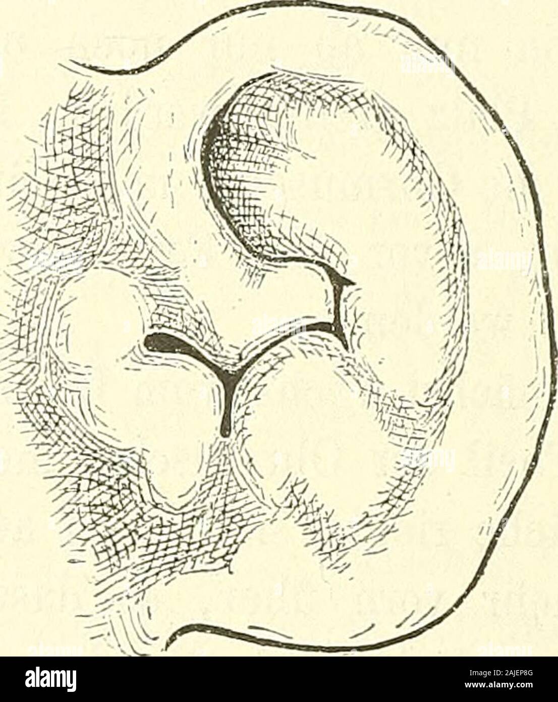 Anatomie menschlicher Embryonen . Fig. 145. Ohr Fötus eines von ca. 3)2 cm Nl. Fig. 146. Ohr Fötus eines von ca. 5|2 cm Nl. tiefste Punkt des Ohres ist noch jetzt die Anheftungsstelle der Taenialobularis, und von einem eigentlichen Ohrläppchen kann daher nochnicht die Eede sein. Eine nächste Stufe vom Ende des dritten oder vom Beginn Monats desvierten zeigt auch den unteren Theil der Fossa angulariszu einer engen Spalte umgebildet. Der zurückgebogene Theil desfrüheren Tuberculum anterius berührt jetzt nicht allein den Anthelix,sondern er stösst nach abwärts auch an den Antitragus. In der Zeitb Foto Stock