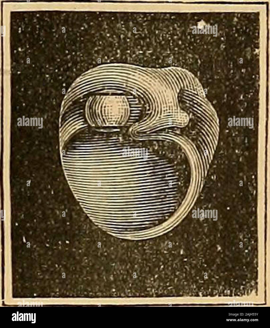 Un libro di testo le malattie dell'orecchio per studenti e professionisti del settore . Fig. 235.-Synechotomy della Fig. 236.-Connective-Tissuefibroso crura della staffa. La formazione nella Eegion della staffa. zione ha cessato è indicata in centrale, a forma di rene, persistentperforations della membrana tympani, se la maniglia di themalleus è fortemente retratto verso l'interno e vi è un considerabledisturbance di audizione (Kessel). 4. Quando vi è un nuovo, fibroso, tessuto connettivo formazione nella regione del incudo-stapedial articolazione e bacino ovalis, 30-2 468 . Le malattie dell'orecchio - da cui il movimento Foto Stock