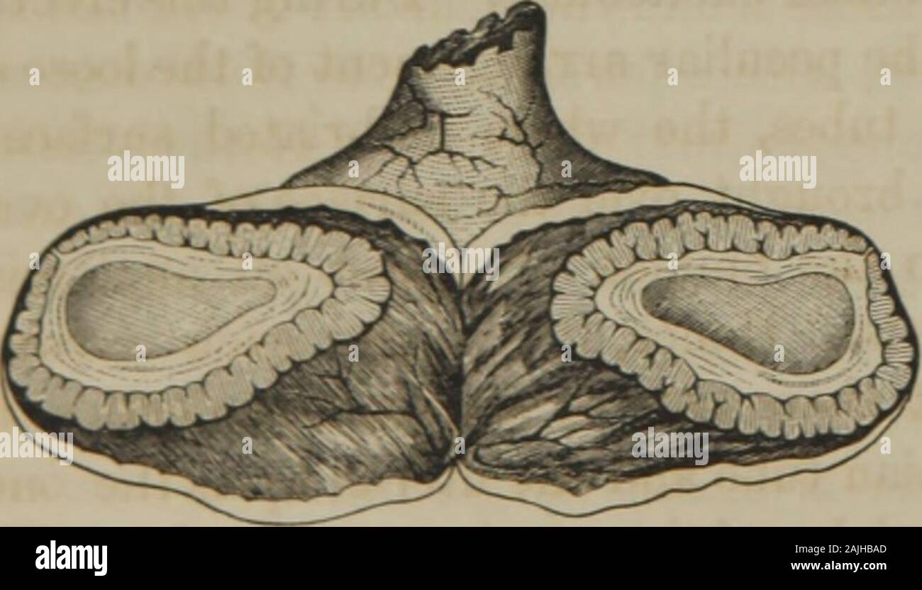 I principi e la pratica di ostetricia . Ovaia, mostrando il corpus luteum nove settimane dopo il ciclo mestruale; da agirl morti di meningite tubercolare. (Dopo Dalton.) la vergine, dopo la terza settimana, questo corpo diminishesin dimensioni e di solito scompare dalla settima o Fig. 13.. Corpo luteo di gravidanza, alla fine del secondo mese; da un womandead dall aborto indotto. (Dopo Dalton.) ottava settimana, una piccola cicatrix da soli che indica posizione itsformer. Nella donna incinta il corpo luteo continuesto essere sviluppato anche il quinto o sei mese di utero- Foto Stock
