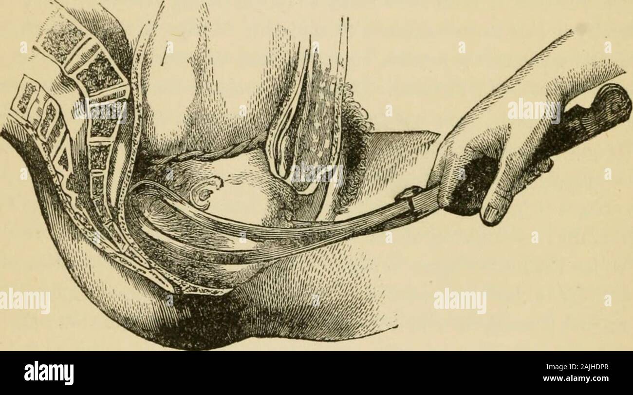 Encyclopaedia - Wikizionario di ostetricia e ginecologia . dire, la demenza fronto-diametro mentale risiede nel antero-posteriore del bacino. Il bi-malar diametro trasversale del thepelvis. La lama sinistra viene inserita prima a sinistra sul lato destro di theface, la lama destra seconda a destra sul lato sinistro del viso e la 132 di un trattato di ostetricia. curva minore rivolta verso tlie S3mpliysis. Sarà sufficiente togently sollevare tlio la pinza e la testa apparirà, ni successione, da itssub-gli uomini-frontale, sub-gli uomini-bregniatic, sub-mento-occipitale di diametri.(Fig. 103.) 2. Mento-Po sacrale Foto Stock