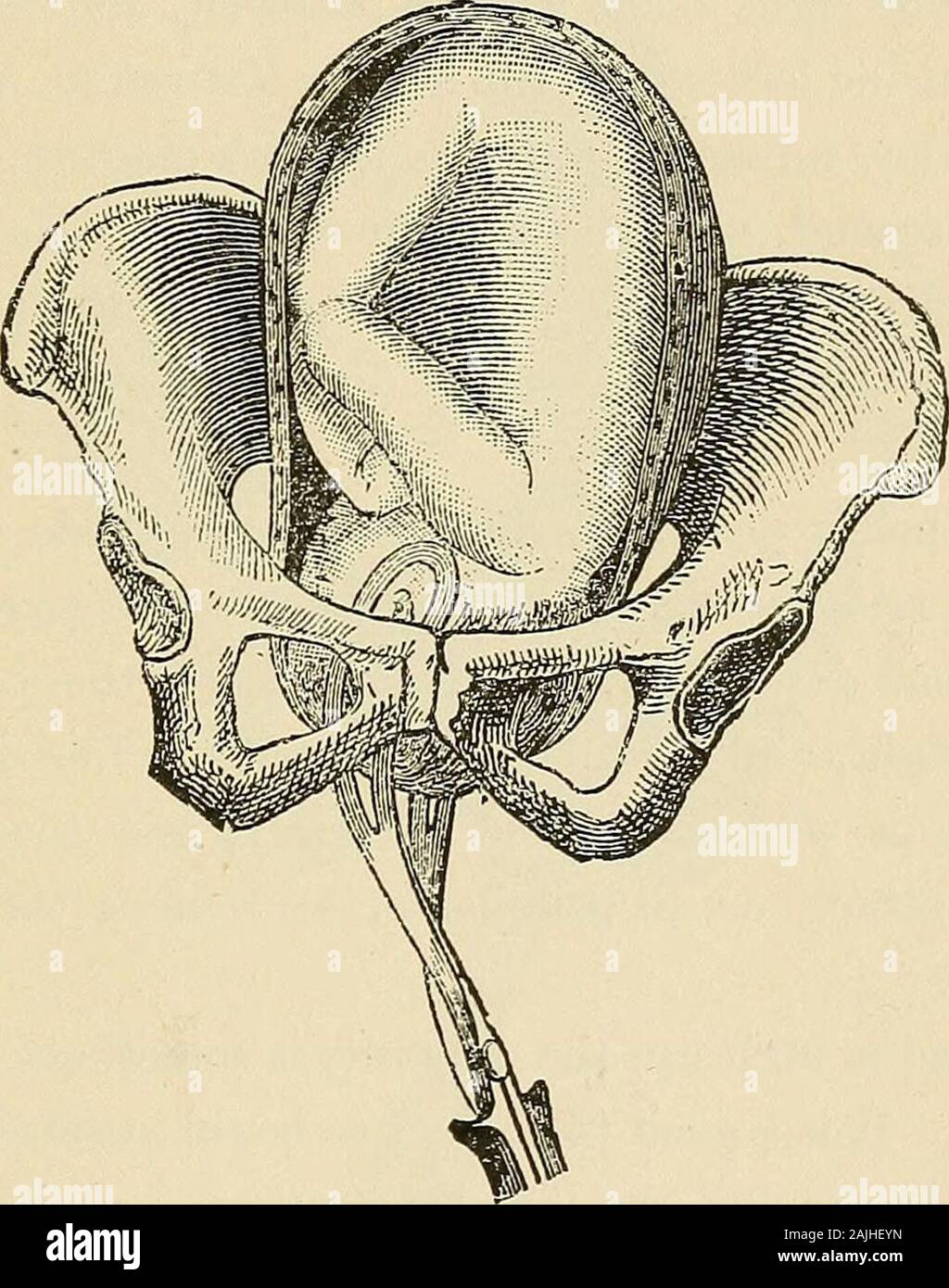 Encyclopaedia - Wikizionario di ostetricia e ginecologia . la testa, dopo Mme. Metodo Lachapelles. Theforceps, quando è bloccato, saprà cogliere l'occipite dalla sua curva minore directedtoward la coscia sinistra della madre. (Fig. 99.) Il primo tractionsshould mirano a portare la testa verso il pavimento pelvico, e poi isto di essere ruotato da sinistra a destra per portare l'occipite sotto la pubes.Questo una volta compiuta, lo strumento è simmetrica alla testa e al FOECEPS. 121 il bacino ed estrazione è proceduto con come nel caso di occipito-pubica a posi zioni. 4. Posizione O.ZX. T.--qui è impossibile afferrare la testa Foto Stock