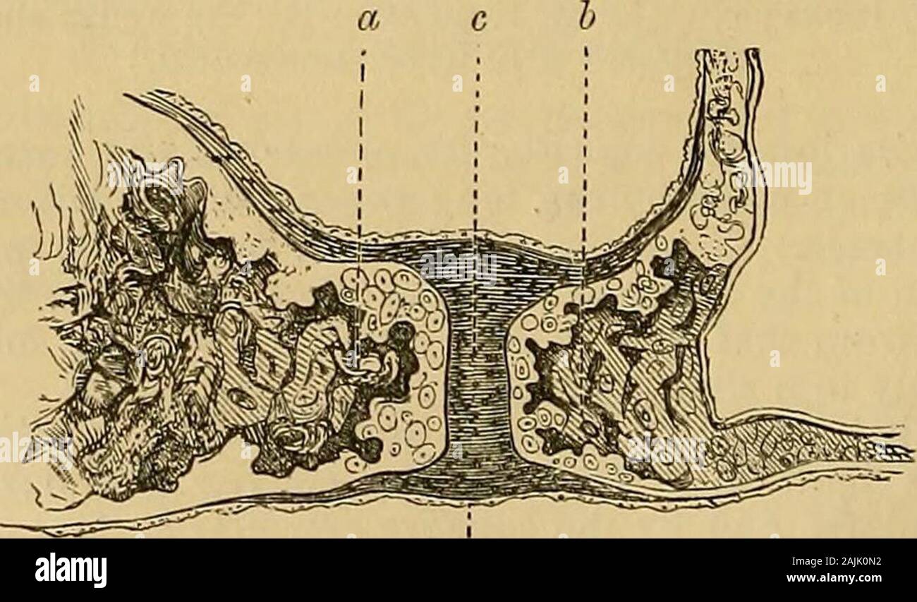 Un libro di testo le malattie dell'orecchio per studenti e professionisti . un 1c g m Fig. 32.-Sezione attraverso il Incudo-stapedial articolazione. un terminale pezzo di lungo le epoche della incus, il quale è collegato da tissuewith fibroso o, il processo lenticolare ; st, Capitulum stapedis; g, la cavità del giunto conla menisco ; c, c, la cartilagine ialina a copertura delle superfici articolari ; k, k,della capsula articolare ; m, il tendine del muscolo stapedius. della fenestra ovalis sono ricoperte da un sottile strato di cartilagine ; questo, in funzionedella Eisell, anche linee la superficie vestibolare della staffa, e enclo Foto Stock