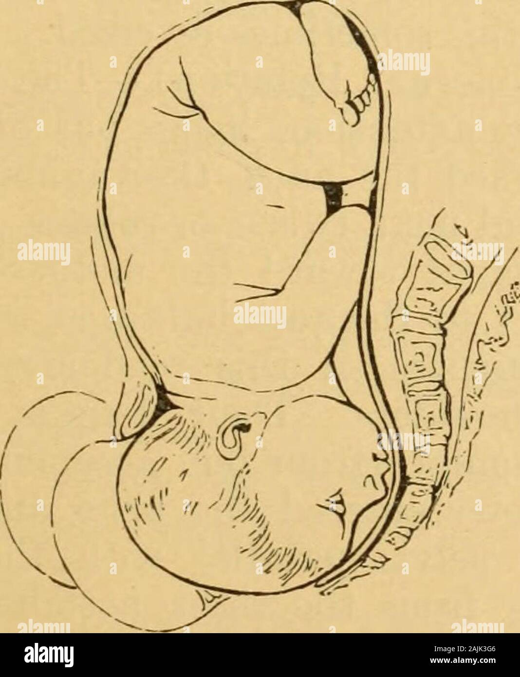 Un manuale pratico di ostetricia . Occipite a meno stretto dopo la rotazione della superficie inclinata di osso nella parte anteriore della spina dorsale ischiatica-theso-chiamato anteriore sinistro a piano inclinato e scivolare verso il basso,in avanti e verso l'interno verso la linea mediana, raggiunge thesymphysis pube, mentre la fronte, ruotando verso il basso, back-Ward e verso l'interno verso la linea mediana (lungo il diritto Fig. 53.. Una estensione verso l'alto di occipite. posteriore piano inclinato), raggiunge il centro del sacro.quindi la testa ovoidale è venuto ad occupare una posizione di concordare 188 manodopera in presentazioni di testa. con la più lunga (anteroposteriore Foto Stock