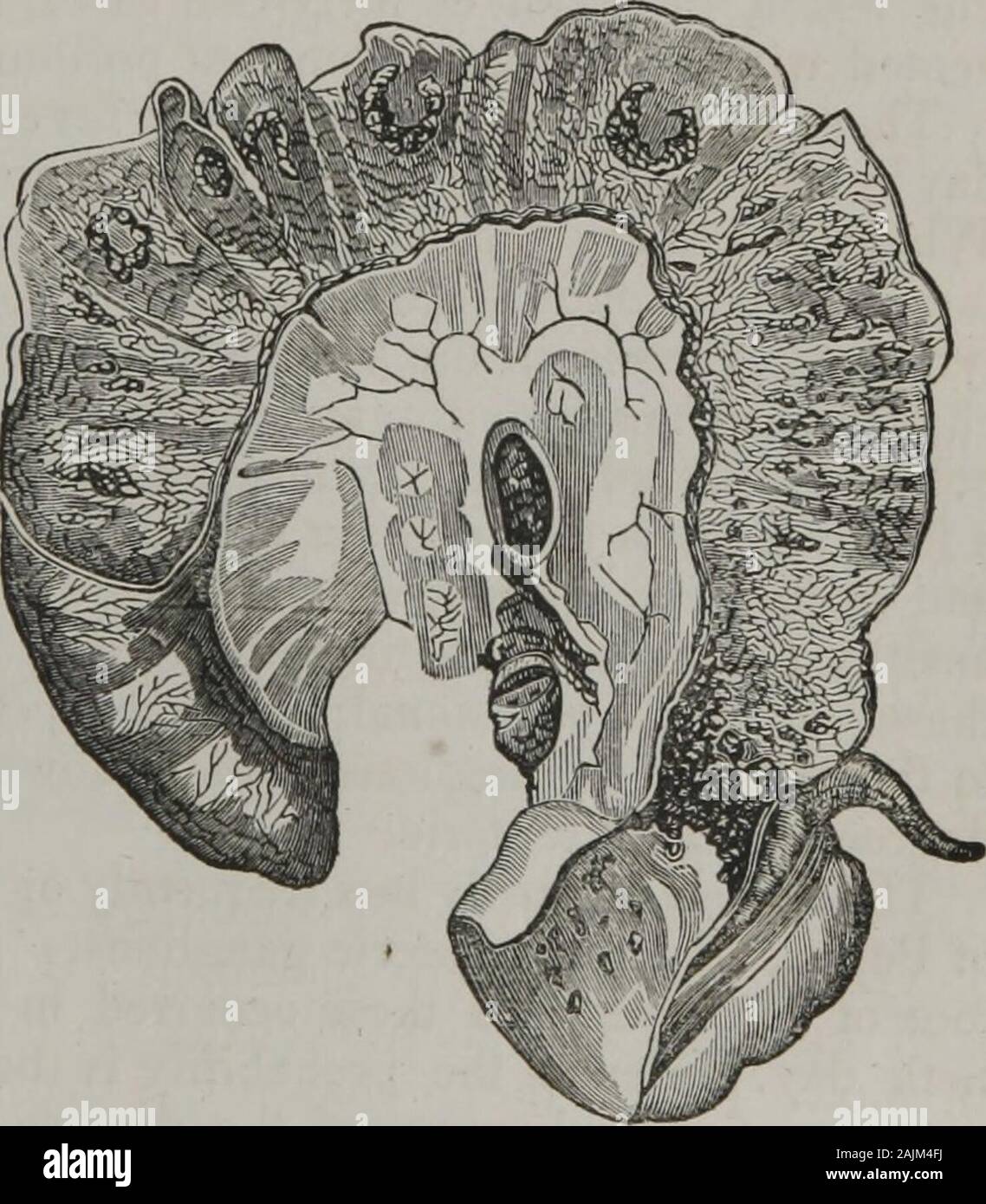 Elementi di anatomia patologica . meno colpite saranno l'ag-minated ghiandole, e il mucousmembrane tra loro. Fig.137, da Cruveilhier, mostrale devastazioni, a questo advancedstage, della malattia e l'en-grandi condizioni del mesen-teric ganglions. Spesso non è che questi ulcerserode la copertura peritonaeal,un',d e quindi portare alla perforazione. Ne-vertheless tale evenienza isoccasionally incontrato e isalways rapidamente fatale. Per foration è generalmente solo da due a tre linee di diametro, irregularlyrounded e vicino all'ileo-coecal valvola. È più frequente in mildergra Foto Stock