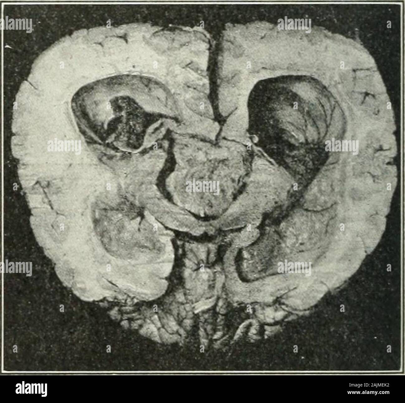 Un manuale di riferimento delle scienze mediche, abbraccia tutta la gamma di scientifici e pratici della medicina e scienza alleate . Il tremore è usuallyon il lato della lesione e del athetoid tj^pe.Se la lesione si trova al di sopra della decussation o involvesthe nucleo rosso in sé, è sul lato opposto e isof il choreiform o paralisi agitans varietà. Seil rubrospinal tratto viene coinvolto dopo il tremore decussationthe diventa di nuovo homolateral. Esso nonè detto ancora che uno può essere troppo positiva come a thecorrelations tra la localizzazione e la qualità del tremore. Questo è uno di t Foto Stock