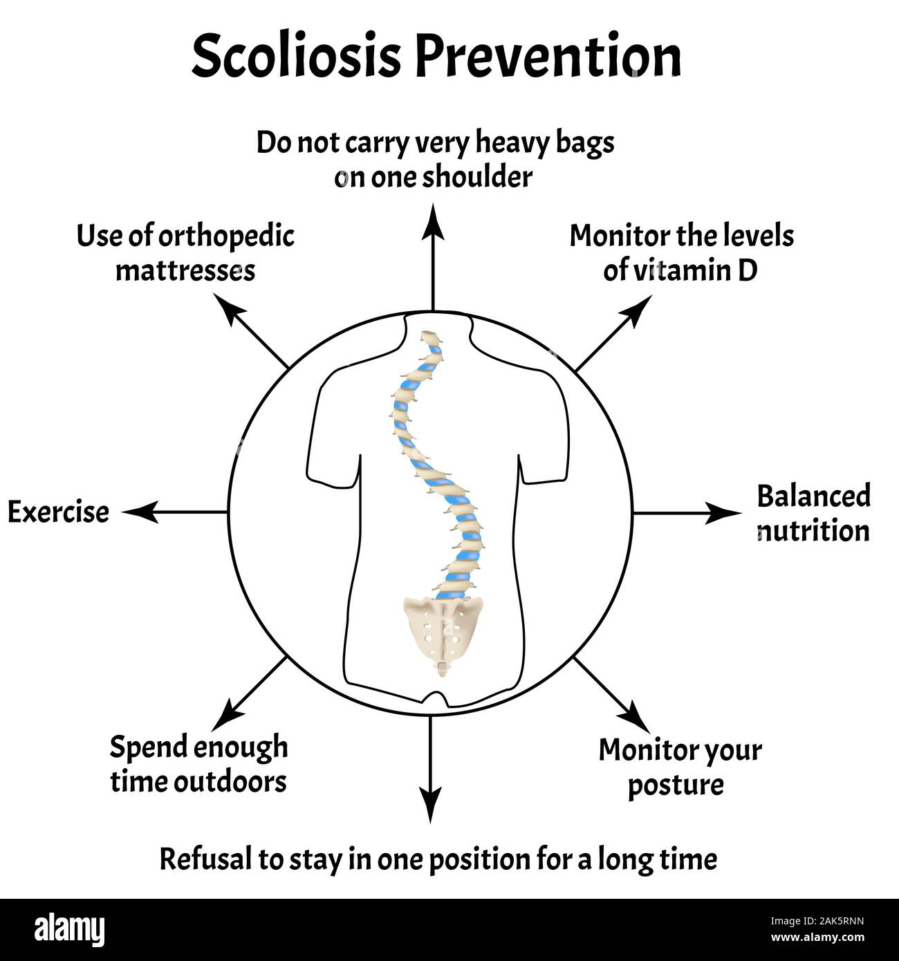 Prevenzione della scoliosi. Curvatura spinale, cifosi, lordosi del collo, scoliosi, artrosi. Postura errata e stoop. Infographics. Vettore Illustrazione Vettoriale
