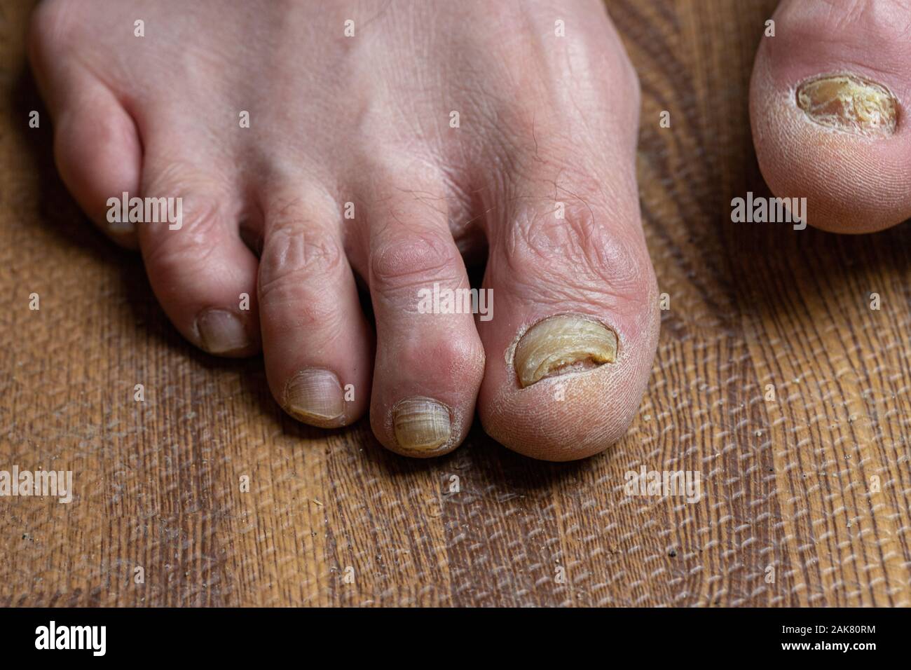 Close up del fungo toenails e punte arricciate affetti da morbo di Parkinson Foto Stock