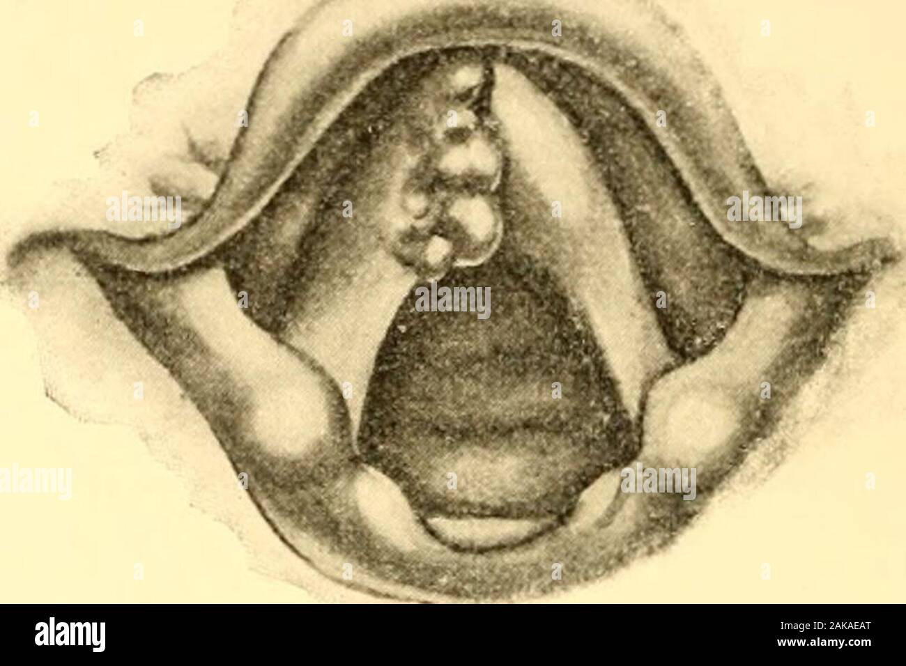 Malattie del naso e della gola . arynx che la malattia è molto moreextensive quello che è apparso in uno specchio, in modo tale che quanto promesso tobe una parziale asportazione deve essere convertito in un completo laryngec-tomy. Il carcinoma della laringe. Per molti anni i termini il sarcoma e carcinoma venivano usate inter-changeably per indicare la malattia maligna. Confusione su questo pointhas stato in gran parte fugati dalla limitazione del termine di carcinoma toepithelial crescita tissutale. Cancro della laringe può egli estrinseca, intrinseco, o una combinazione di entrambi.Krishaber include in primo luogo quelle lesioni che coinvolgono l'epiglottide, 352 DISE Foto Stock