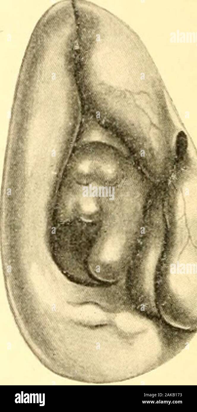 Malattie del naso e della gola . Fig. 81. Adenoidi in archivio della faringe visto attraverso AnteriorNares dilatata. (Griinwald.) un modo descritto altrove (p. 35). La sensazione convogliato a thefinger da una massa di adenoidi è inconfondibile. Esso è stato paragonato a tali di un mucchio di vermi di terra. La forma morbida delle adenoidi iselastic, comprimibile, lobulated e vascolare, in modo che il examiningfinger sul suo ritiro è macchiato di sangue anche se butlittle forza è stata utilizzata. Il disco la varietà è più resistente andsmoother nonché meno vascolare. Se una vista rhinoscopic è possiblethe archi del choan Foto Stock