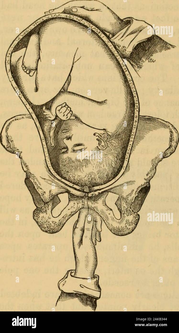 Un sistema di ostetricia : comprese le malattie della gravidanza e stato puerperale . e l'orlo, specialmente se l'utero beactive. Quando l'otturatore è arrivato a circa il diametro trasversale dell'utero, la testa avrà eliminato la tesa e la spalla opposta avrà il sistema operativo. Che è spinto in modo simile come la testa, edopo un po' di ulteriore depressione della culatta dal di fuori il kneetouches il dito e può essere agganciata verso il basso da esso. Molto frequentlyhappens, quando le membrane sono perfette, che, non appena il feltro shoulderis la culatta e piedi provengono per il sistema operativo in un mome Foto Stock