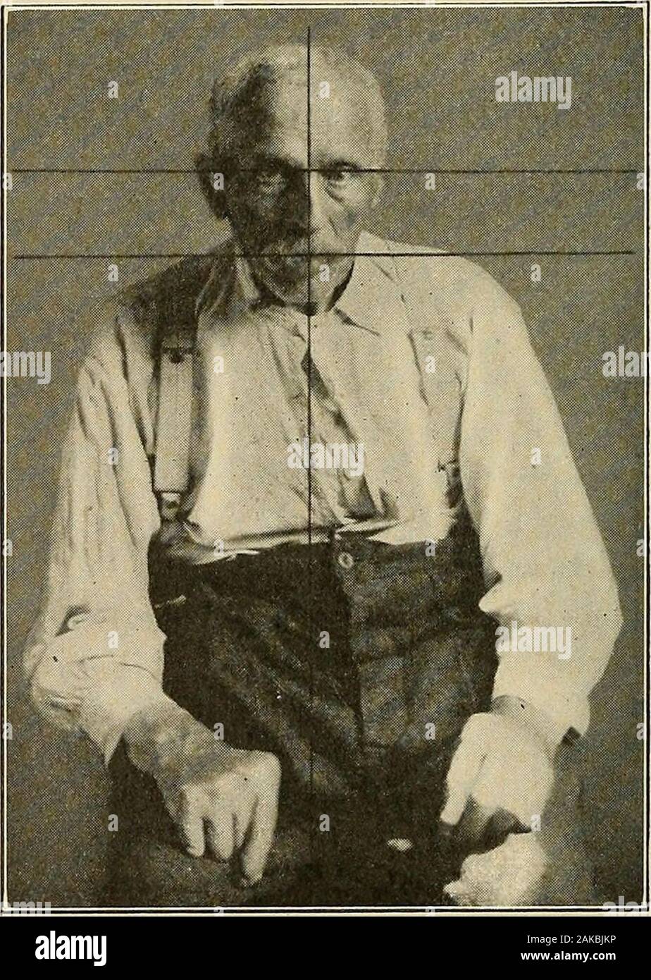 Malattie del sistema nervoso : un libro di testo di Neurologia e psichiatria . ients aprono i loro occhi dopo closingthem con difficoltà. Uno di noi ha visto questo come un sintomo iniziale. 1 Furstner et al.; vedere Zingerle. 426 paralisi agitans, Huntington, disturbi relativi ai pazienti di leggere con difficoltà a causa della rigidità del theocular movimenti. Palsies oculare può causare-pseudo-ophthalmo-plegias. Uno di tanto in tanto si trova lento reazioni pupillari. Il pharyn-geal e muscoli laringea essendo coinvolti, come gli altri nel corpo, resultsin lenta e difficile discorso, diventando sempre più debole e più debole come il passare degli anni Foto Stock