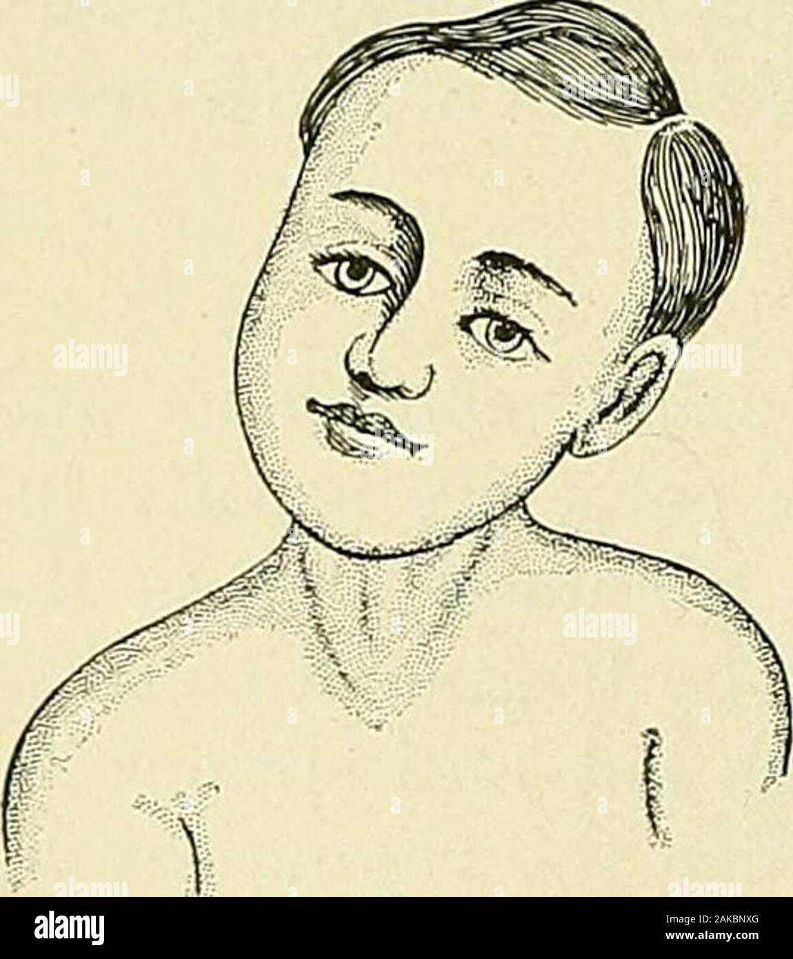 Un manuale per la moderna chirurgia : una esposizione delle dottrine accettato e approvato le procedure operative del tempo presente, per l'uso degli studenti e dei professionisti . P 1 ,• -1 •-• tenutosi tor un lungo periodo di tempo in una posizione tesa,come nella infiammazione delle ghiandole cervicali; miosite, o inflamma-zione dei muscoli, dovuti a reumatismi, gotta o altre cause ; per spasmof muscolo indotta, probabilmente, da lesioni del nervoussystem centrale ; per lo spasmo muscolare il risultato di lesioni e di irritazione reflex,come vermi intestinali. Una lieve forma di torcicollo avviene dopo l'ex-posure a freddo, e è ca Foto Stock