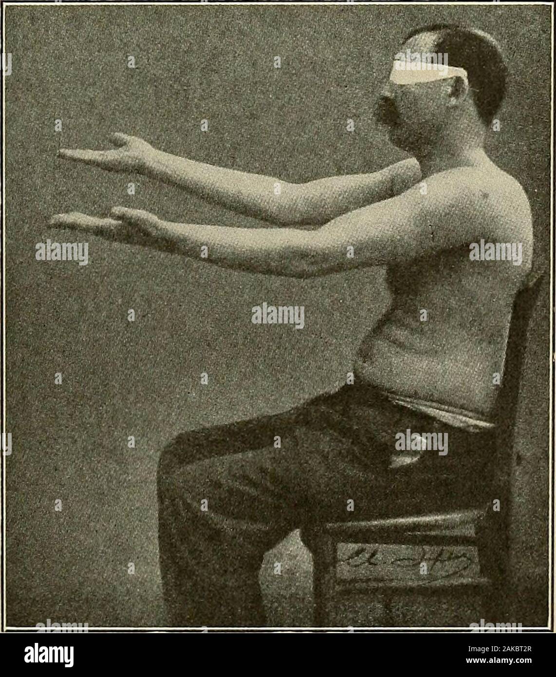 Malattie del sistema nervoso : un libro di testo di Neurologia e psichiatria . Fig. 210.-^andatura cerebellare atteggiamento.(Thomas.) 1 Stewart e Holmes, cervello, 1904. Sintomi 407 atassia è una costante, non crescente come in un intenzione tremore(con diverse gradazioni, per la ferma intenzione di tremori di mul-tiple sclerosi multipla sono spesso dovuti ad interferenza con i meccanismi di cervelletto). J - la Fig. 211.-Test per dysmetria in disturbi cerebellari.. Fig. 212.-mostra dysmetria cerebellare. Adiadokolxinesis.-descritto originariamente da Babinski come carattere-istic di malattia cerebellare, questo sintomo, consistente o Foto Stock