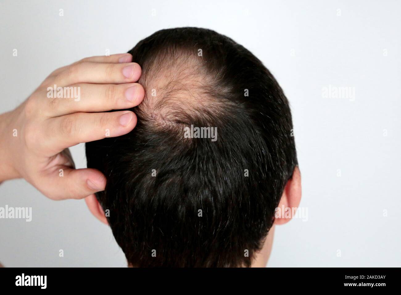 Calvizie, uomo preoccupato per la perdita di capelli. Testa maschio con un calvo su sfondo bianco Foto Stock