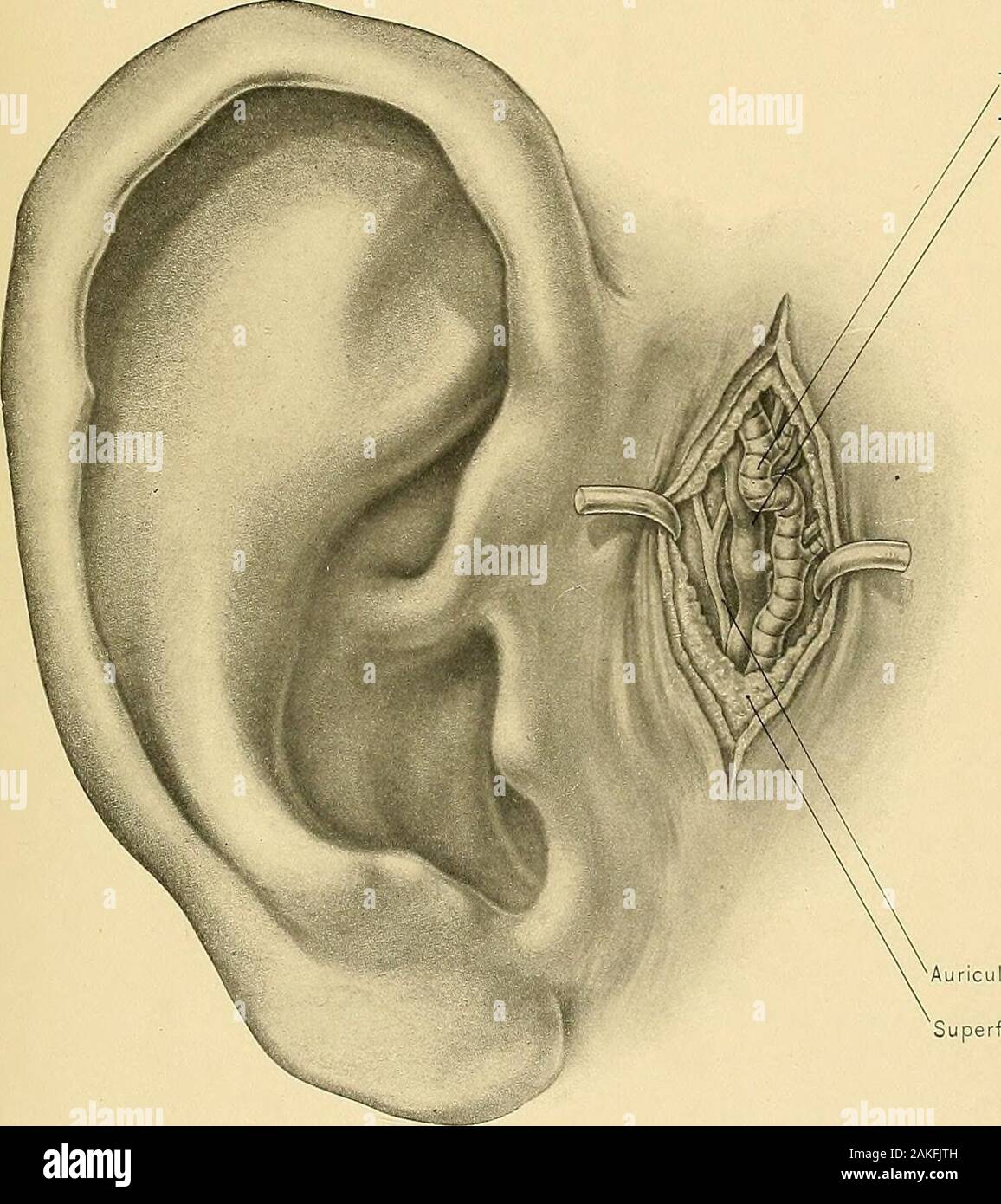 Anatomia chirurgica : un trattato di anatomia umana nella sua applicazione alla pratica della medicina e chirurgia . Princeps cervicis a.Sterno-mastoide m. Esposizione di arteria occipitale per la ligazione.piastra 192 CXCIV,. Un temporale.Temporal v. o-temporal n.fascia superficiale ESPOSIZIONE DI AURICULO-temporale e nervose arteria temporale.11-13 193 la ligazione delle arterie DELLA TESTA E DEL COLLO. 195 è la seguente: può terminare come submental arteria, la sua area di distri-possono offrire un contributo significativo in faccia essendo alimentato dal ramo nasale del oftalmica, thetransverse viso, o l'interno dell'arteria mascellare. L arteria occipitale ho Foto Stock