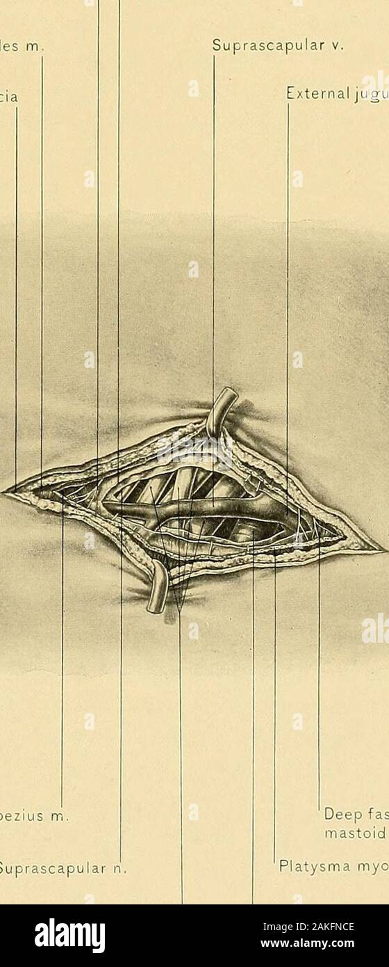 Anatomia chirurgica : un trattato di anatomia umana nella sua applicazione alla pratica della medicina e chirurgia . r,.. Fascia profonda oltre trapezius m. Suprascapular n plesso brachiale (n.) fascia profonda su sterno-mastoide m. Platysma myoidesSubclavian a. Esposizione della terza porzione di arteria succlavia,167 la ligazione delle arterie DELLA TESTA AXD KECK. 169 tratto dell'arteria è anche coperto dalla fascia prevertebral o posteriorprocess del profondo scudo cervicale ed è attraversato dal nervo al subclaviusmuscle. Il sovra-scapolare arter}^ e vena attraversare questa porzione del arteryfrom all'interno verso l'esterno, e u Foto Stock