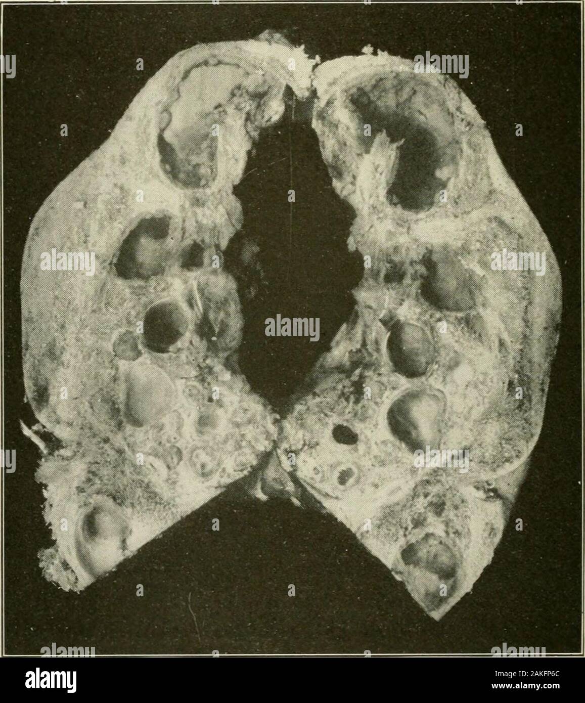 Generale e patologia dentale con particolare riferimento ad eziologia e anatomia patologica; un trattato per studenti e professionisti del settore . Fig. 427. (Nuovo). Un caso di cisti dentigerous che era probabilmente una semplice cisti,tipo A, con tipico epitelio adamantina, con nessun down-crescita, il rivestimento delle cisti. Questo è stato il primo caso riportato withthis tipo di epitelio formante la parete della ciste. f)40 patologia dentale il rivestimento del semplice cisti, tipo B, è costituito da un materiale fibroso tis-sue strato. Alcuni osservatori hanno riportato un rivestimento epiteliale perquesto tipo di cisti anche. Il adamantinomas, sulla sezione, presente solis Foto Stock