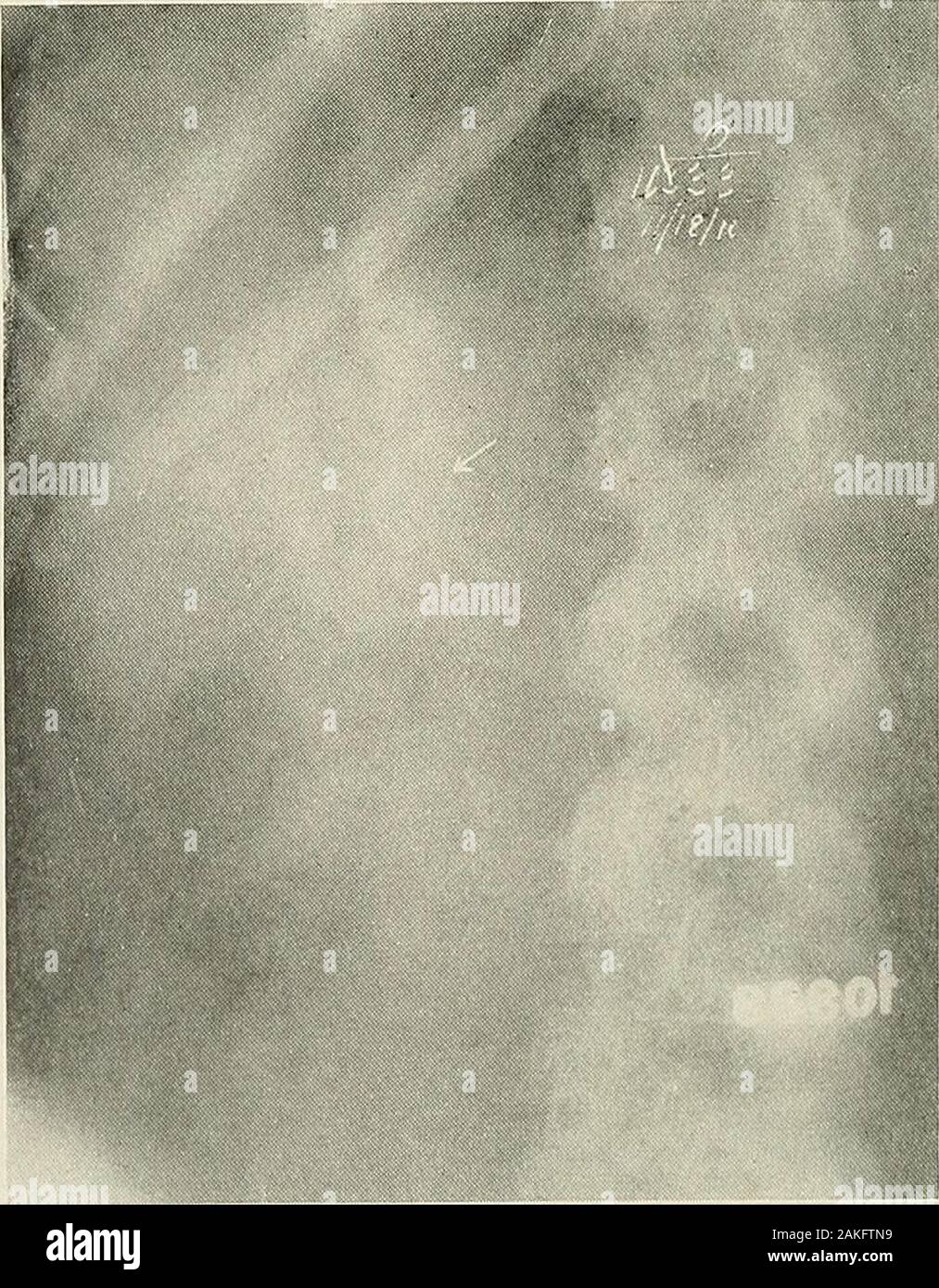 Pyelography (pyelo-ureterography) uno studio del normale e di anatomia patologica della pelvi renale e uretere . Fig. 201.-ombra identificazione (gallo-pietra) (pyelogram di Fig. 200).. Fig. 202.-ombra nella zona renale. Pietra renale 223 cesso che risiede nel polo superiore; tuttavia, la normaloutline del calyces, vero pelvi e uretere excludesuch sarebbe una possibilità. In figura, 198 due ombre irregolari areapparent nel rene destro area. In Fig. 199 Il shadowsare adiacente a quella della pelvi renale, in una situazione che similarto della corticale pietra renale. Tuttavia la mancanza di Foto Stock