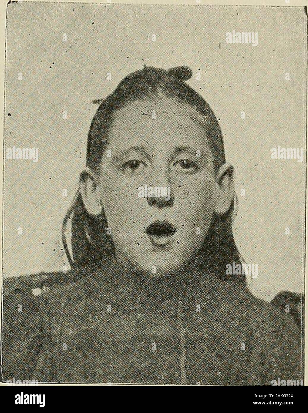 Pediatria : le condizioni igieniche e di un trattamento medico dei bambini . Fig. 233-Adenoideo Facies in un neonato adenoidi 141 facies. La sordità è dovuta sia alla estensione del catarrhalinflammation nelle trombe di Eustachio con swelHng del mucousmembrane, la chiusura dei tubi di ventilazione carenti di middleear, e la retrazione della membrana timpanica, o all'estensione in posizionedi orecchio medio, causando un otite media cronica. Attacchi di acutesuppurative otite media può verificarsi anche di volta in volta, andchronic scaricando le orecchie non sono infrequenti. Allargamento cronica della cervicale lymphnodes, senza Foto Stock