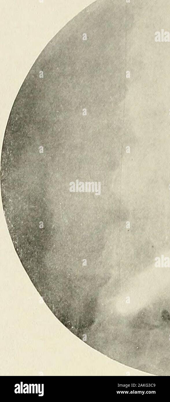 Pyelography (pyelo-ureterography) uno studio del normale e di anatomia patologica della pelvi renale e uretere . Fig. 182.-pietra renale. Fig. 183 una piccola ombra è visibile nel rene sinistro area.In Fig. 184 la stessa ombra è evidente al di là dell'apice del calice caudale ed è distintamente corticali. Il contorno del bacino mostra generale irregolarità infiammatorie come theresult della infezione causata dalla pietra. In Fig. 185 Un stoneshadow è situato all'apice del calice inferiore sporgente andpartially in esso. Il cambiamento infiammatorie trovanella non completamente distesa della pelvi e uretere è evidente. Insufficienza renale Foto Stock