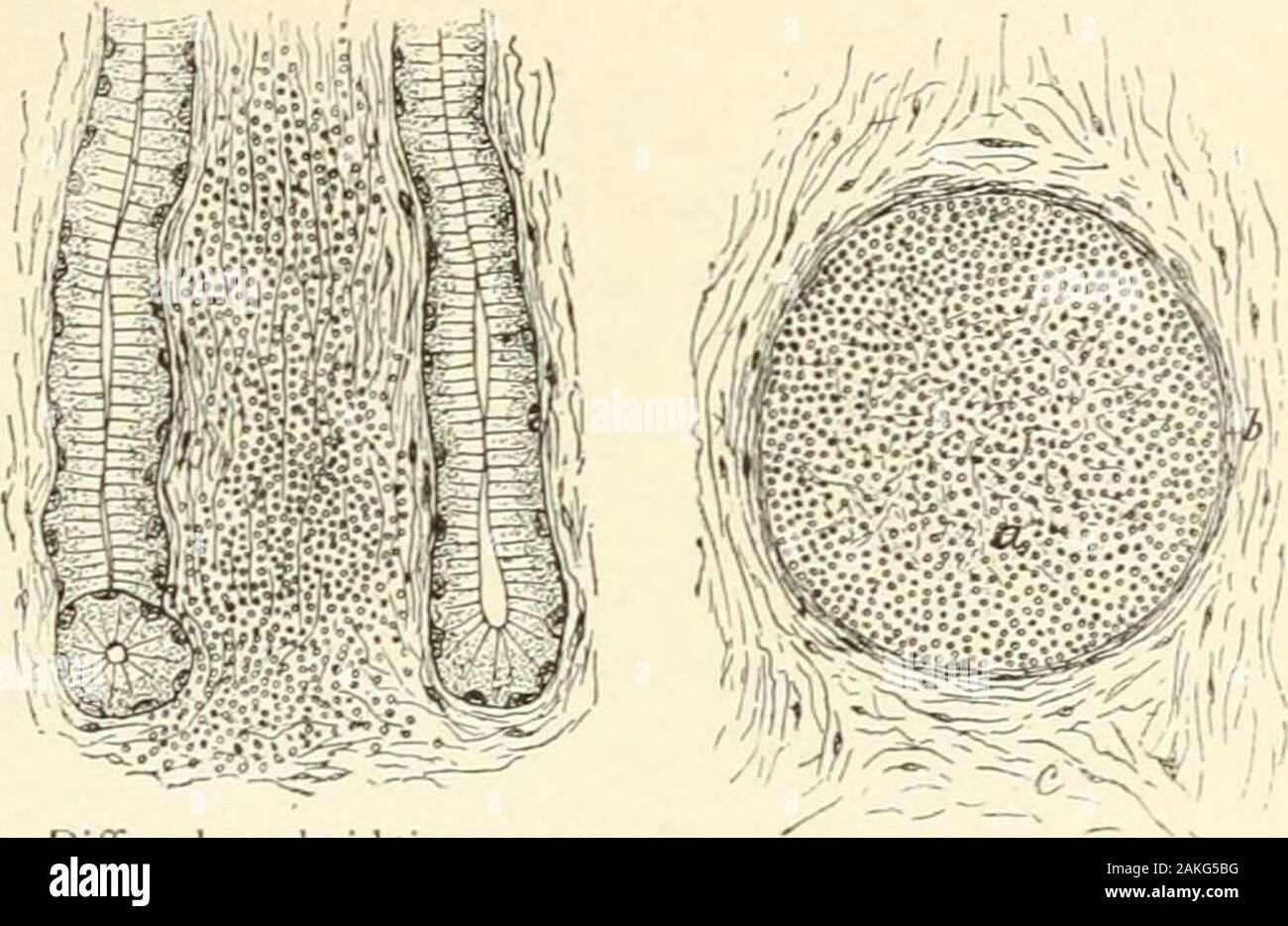 Un libro di testo di istologia normale: tra cui un conto dello sviluppo dei tessuti e degli organi . Elementi di adenoideo tissuefrom spazzolato parzialmente sec-zione della ghiandola linfatica ofchild : un, fibre del reticolo ;b, cellule linfoidi; c, ex-connettivo panded - tissueplate. Il sistema linfatico. Iig. entro la rete di lavoro costituiscono il più denso o forme più lasco tessuto ofadenoid trovati nei noduli linfatici; ordinariamente il cellsare così strettamente posto che il reticolo è grandemente mascherati, satisfactoryviews di quest'ultima essendo ottenuta solo nelle sezioni di grande thinnessor dopo che le cellule sono state re Foto Stock