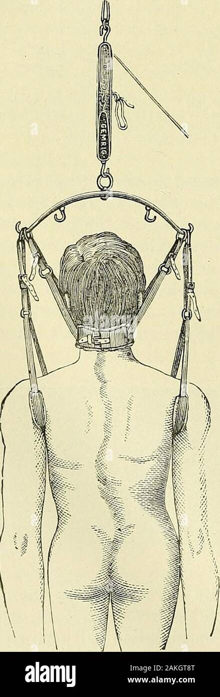 Un manuale per la moderna chirurgia : una esposizione delle dottrine accettato e approvato le procedure operative del tempo presente, per l'uso degli studenti e dei professionisti . Bambini in letto-telaio. (Parco e contro-trazione esercitata su la testa e le gambe possono essere neces-sario mantenere locale di riposo. Pesanti sacchi di sabbia può essere posizionato lungo il lato del paziente per impedire il movimento laterale del tronco. Un piccolo,morbido cuscino può essere posto sotto la colonna vertebrale in corrispondenza del punto dove la figura angolare: 268.. Foto Stock