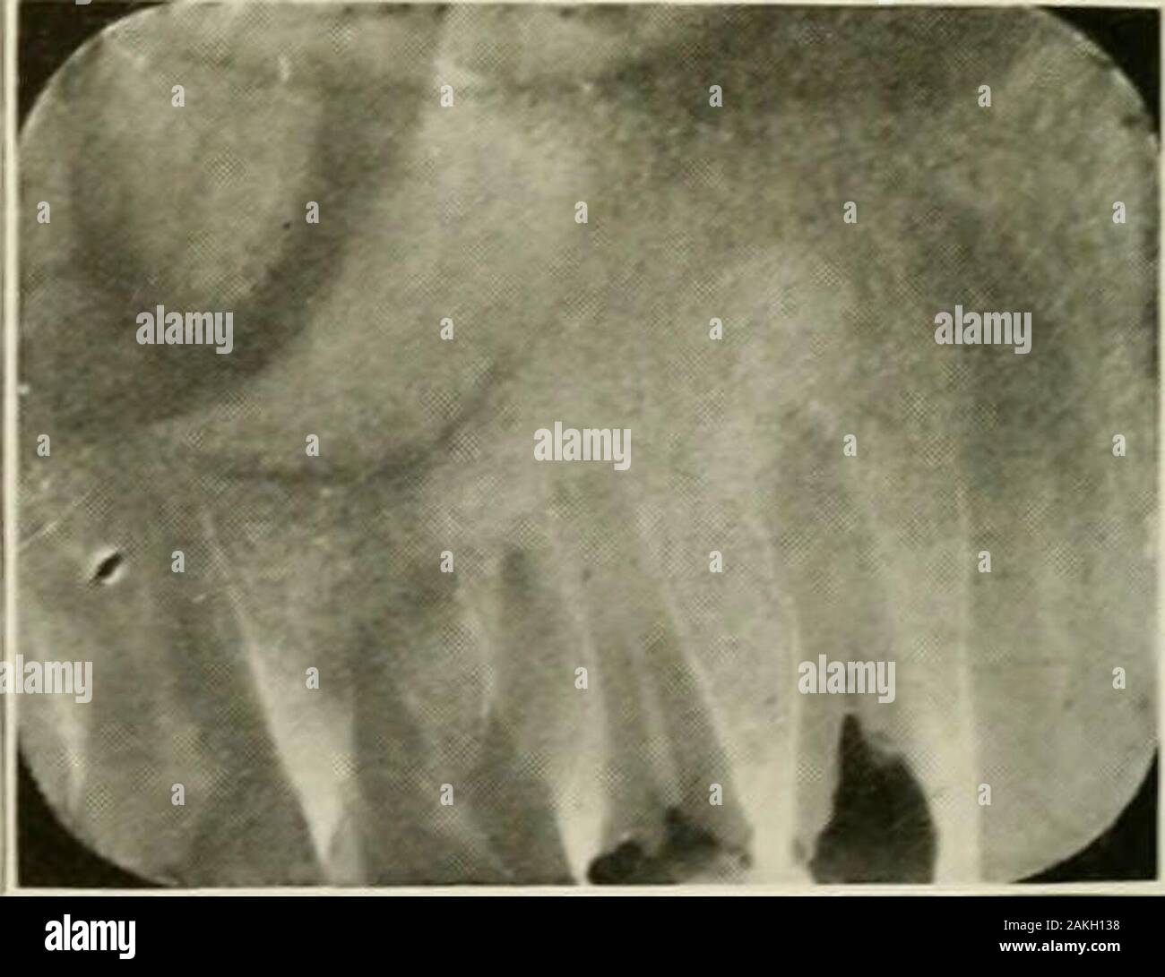 Generale e patologia dentale con particolare riferimento ad eziologia e anatomia patologica; un trattato per studenti e professionisti del settore . Fig. 348.-Dentigerous o root CIST come- Fig. 349.-Dentigerous o cisti radice ted nella sua eziologia con una cronica associata nella eziologia con una cronica dento- dentoalveolar ascesso in un secondo superiore ascesso alveolare in una prima superiore bicuspid.bicuspid. mostrato a lui i resti dello smalto organo-l'epithelialcells di cui dispongono di impigliarsi nel peridental tissueswherein rimangono a riposo fino a un certo grado di irrita-zione conduce alla loro proliferazione. Foto Stock