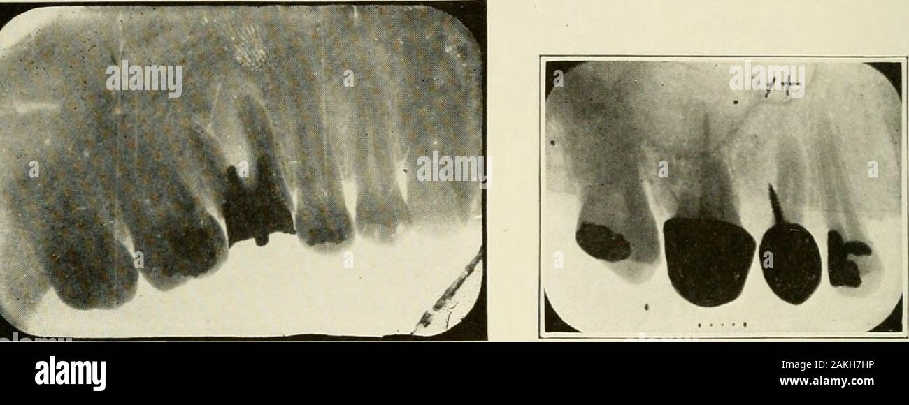 Generale e patologia dentale con particolare riferimento ad eziologia e anatomia patologica; un trattato per studenti e professionisti . d il trifurcation ofmolars. In alcuni casi il processo alveolare e gengiva tis-Luisa Rossi dal margine gengivale alla perforazione di scomparire (fol-abbassamento della infezione di area perforata del peridentalmembrane) al livello della perforazione, esponendo che muchof superficie di radice. Vari di tali facilita venuti sotto il nostro ob-prenotazione. Un altro interessante causa di ascesso alveolare è intraalveolarroot le fratture causate da esterno traumatismi gravi (Fig. 341 Foto Stock